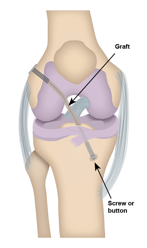 ACL reconstructive surgery: graft and screw in place