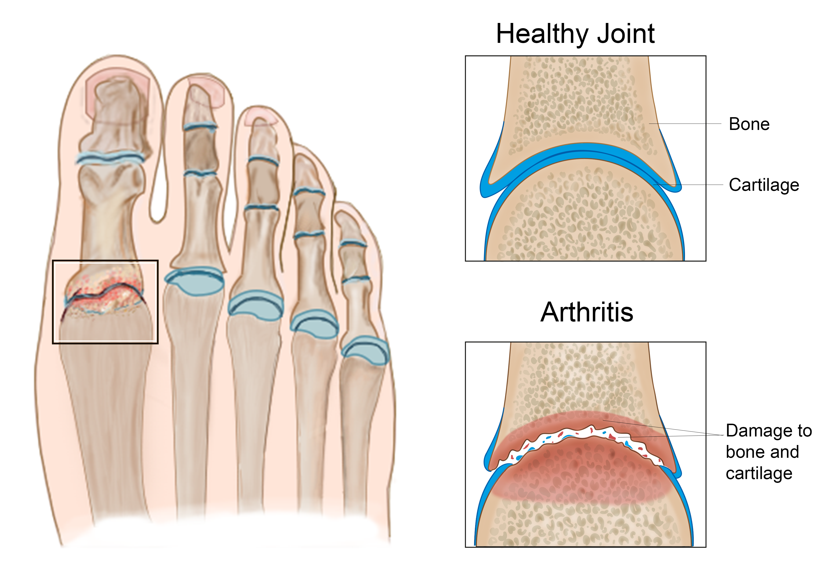 Toe joints, showing a healthy toe joint and an arthritic toe joint