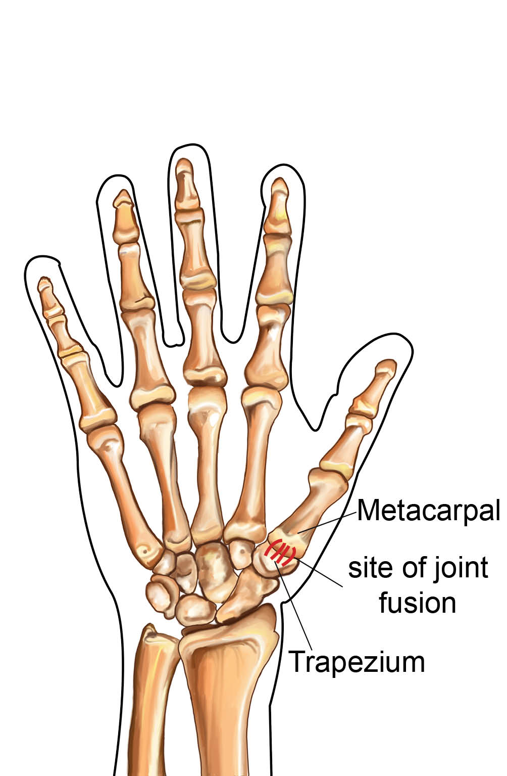 Diagram showing the metacarpal and trapezium bones in the thumb.