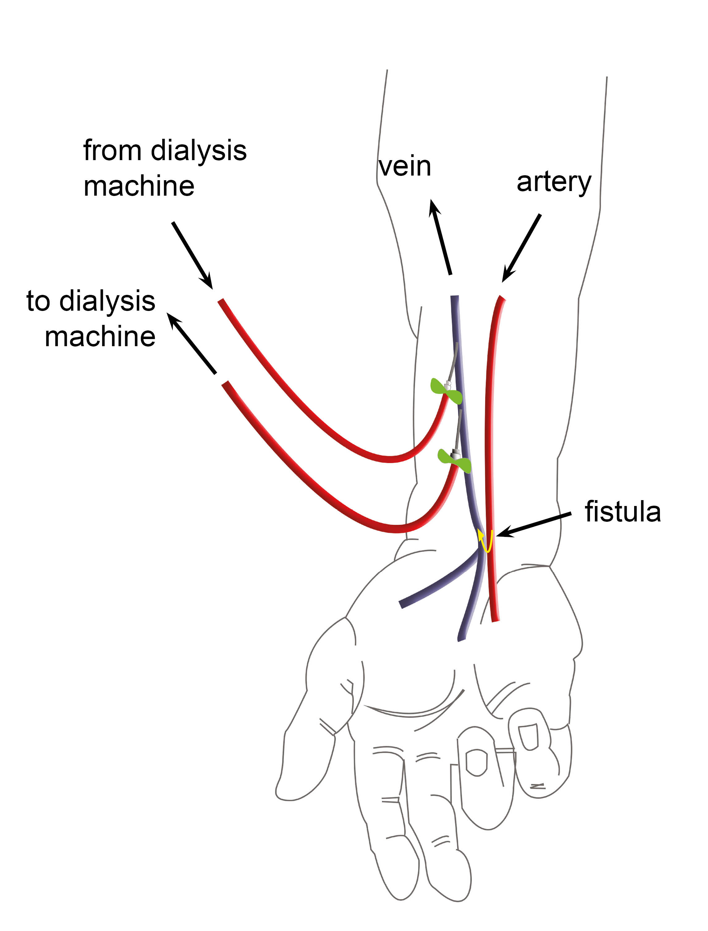 Diagram showing the vein and artery, plus the tubing where the blood flows through the first needle out of the body, through the dialysis machine and back through the second needle into your body