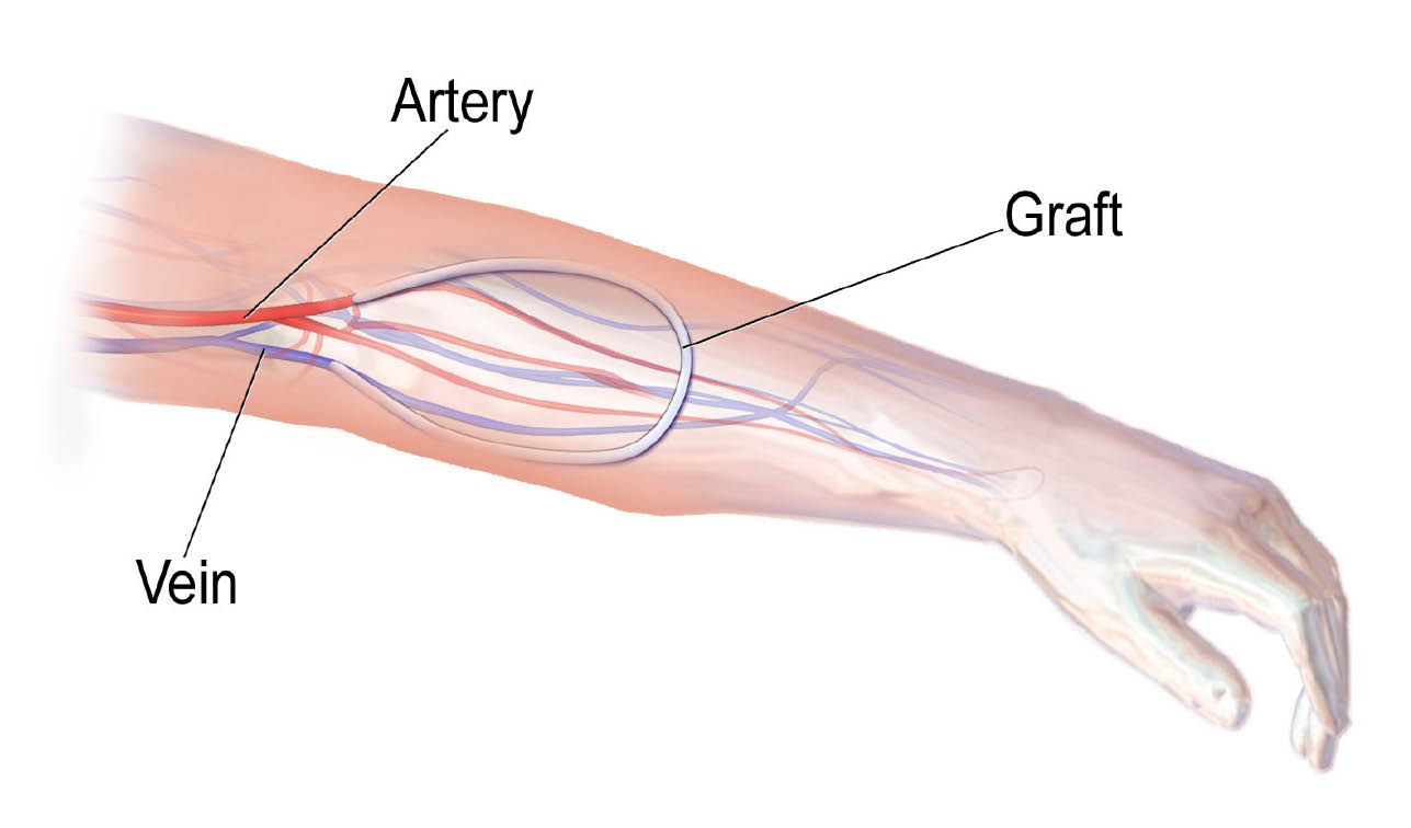 Diagram of an arteriovenous graft in your arm