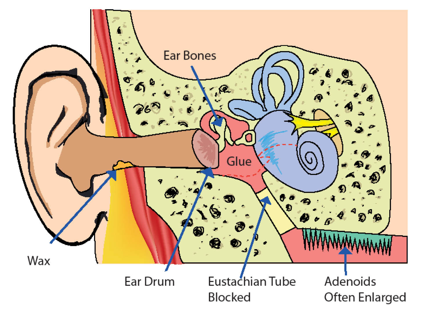 Eustachian Tube blocked behind the ear drum