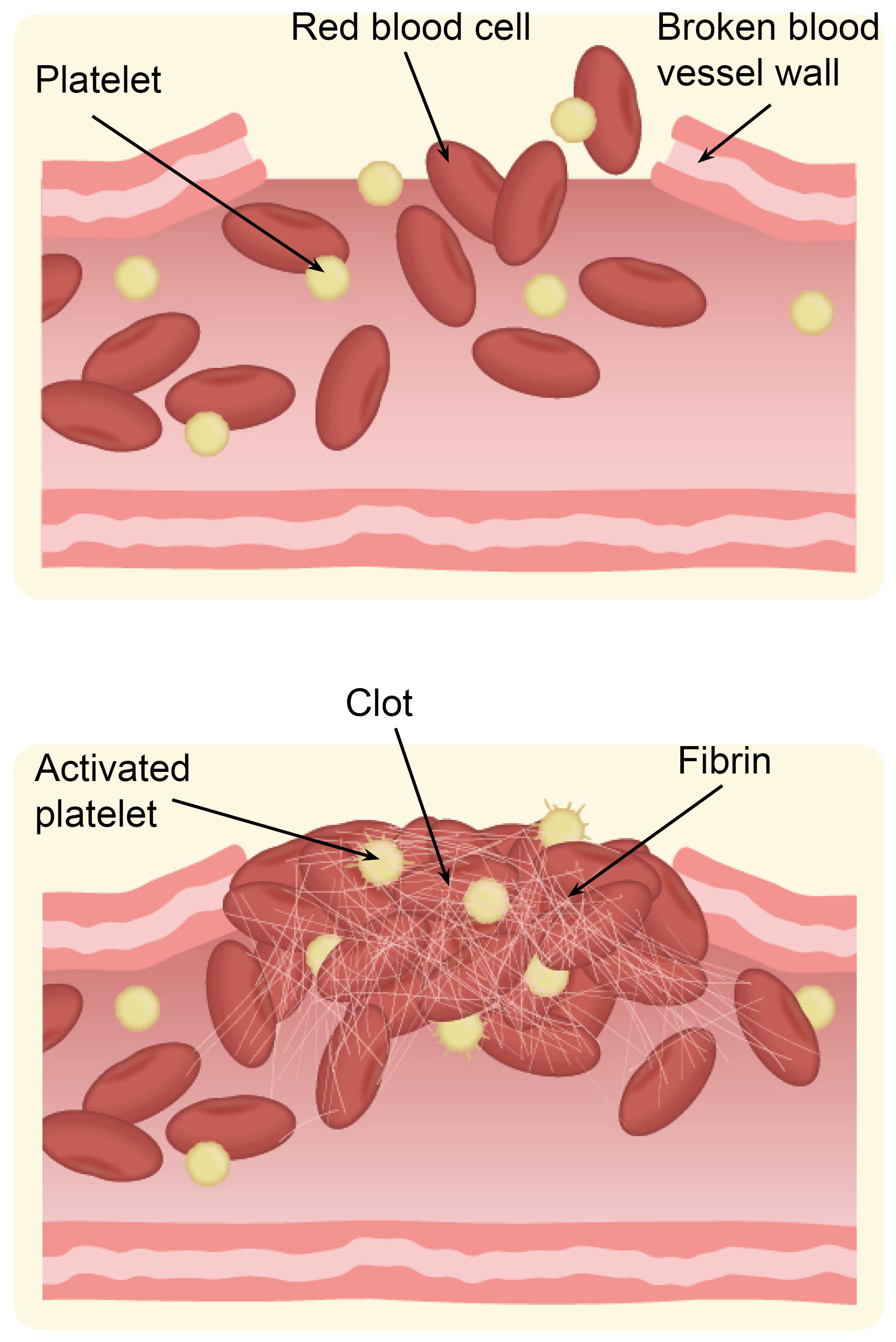 Showing how a plug is formed to stop the bleeding.