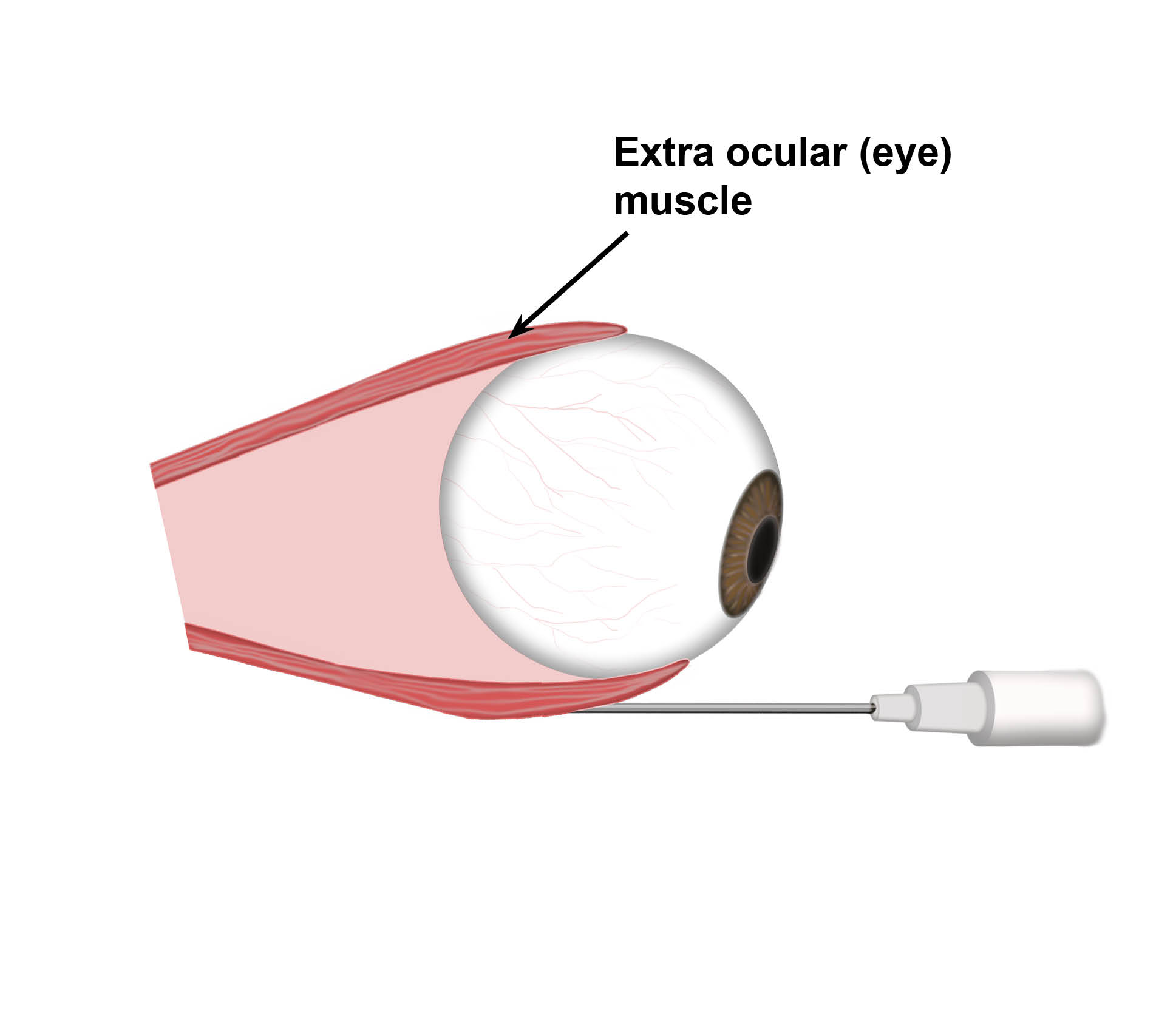 Botulinum toxin injection into extra ocular muscle, for correction of squint
