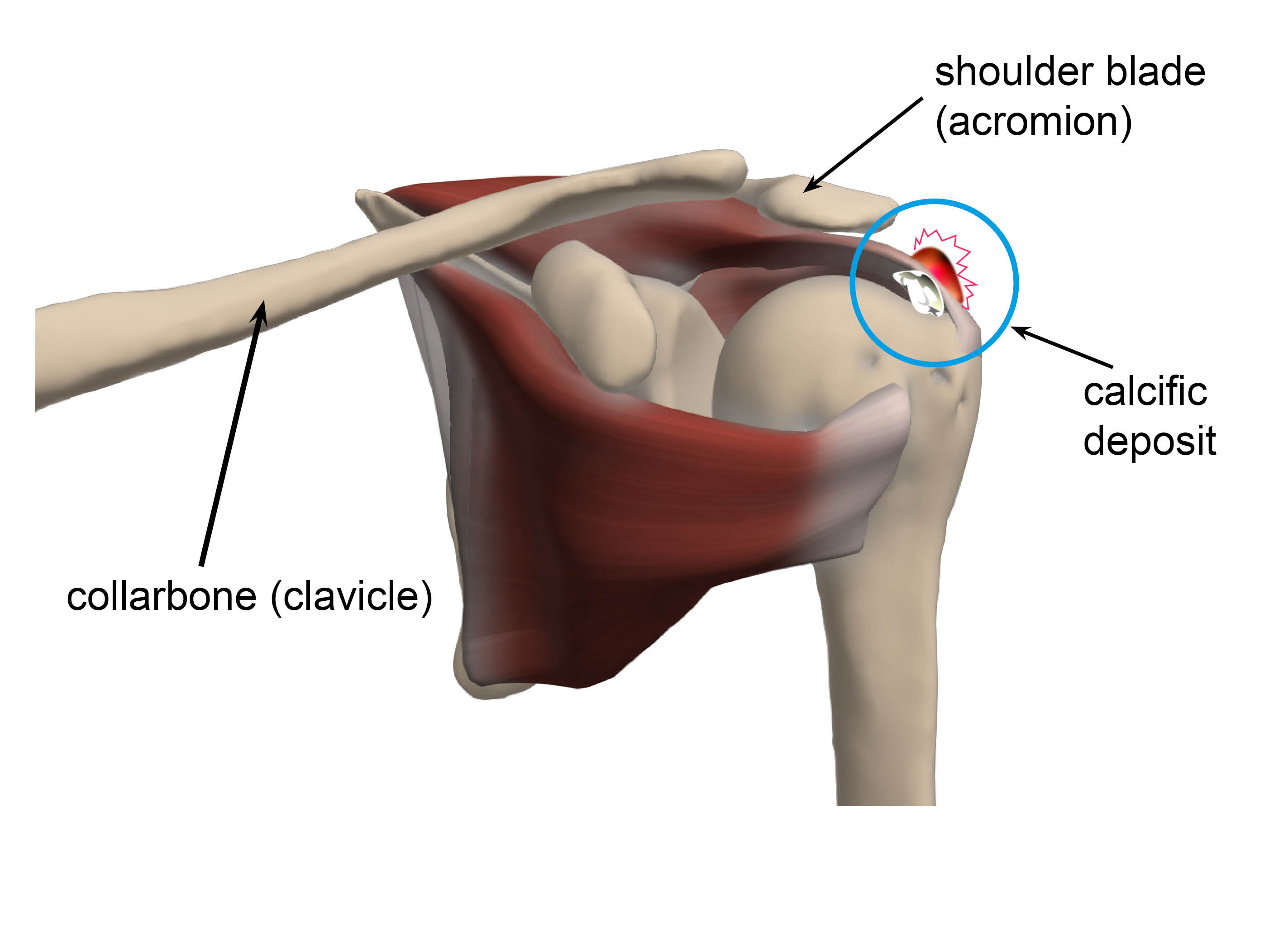 Diagram showing a calcific deposit inside the rotator cuff