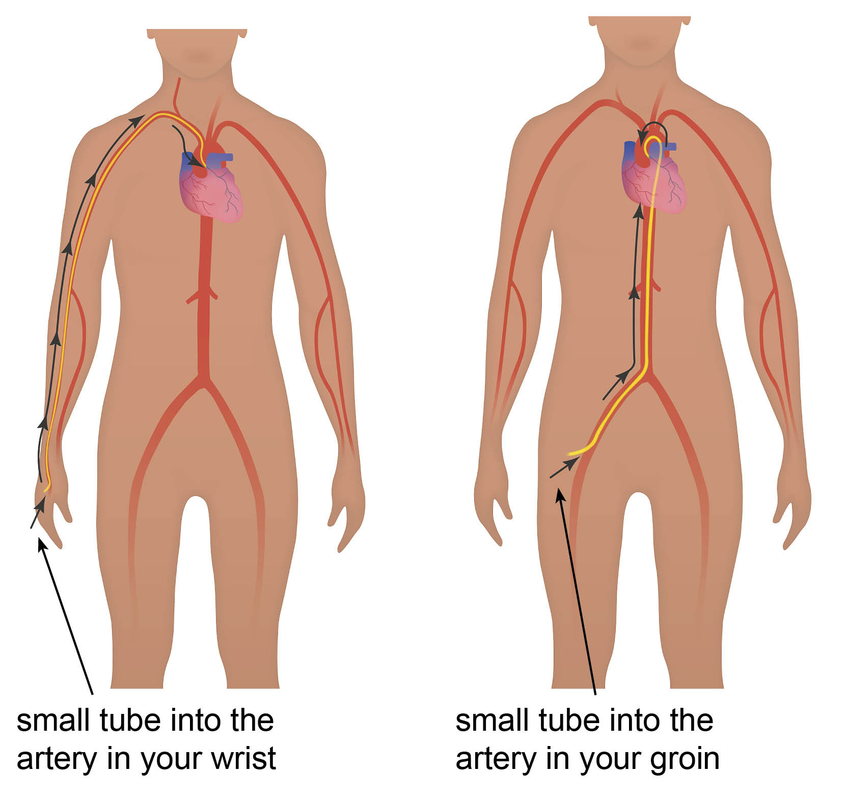 catheter-insertion-points.jpg