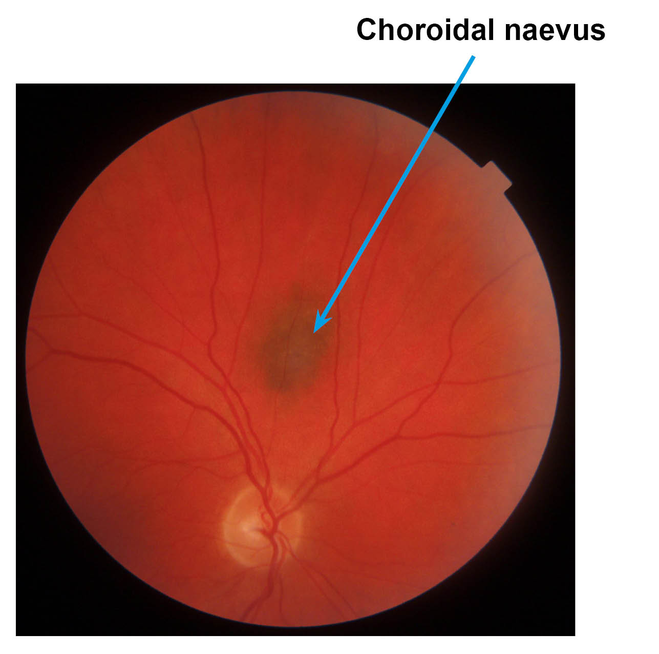 Scan of an eye with a small shadow (freckle) in the middle