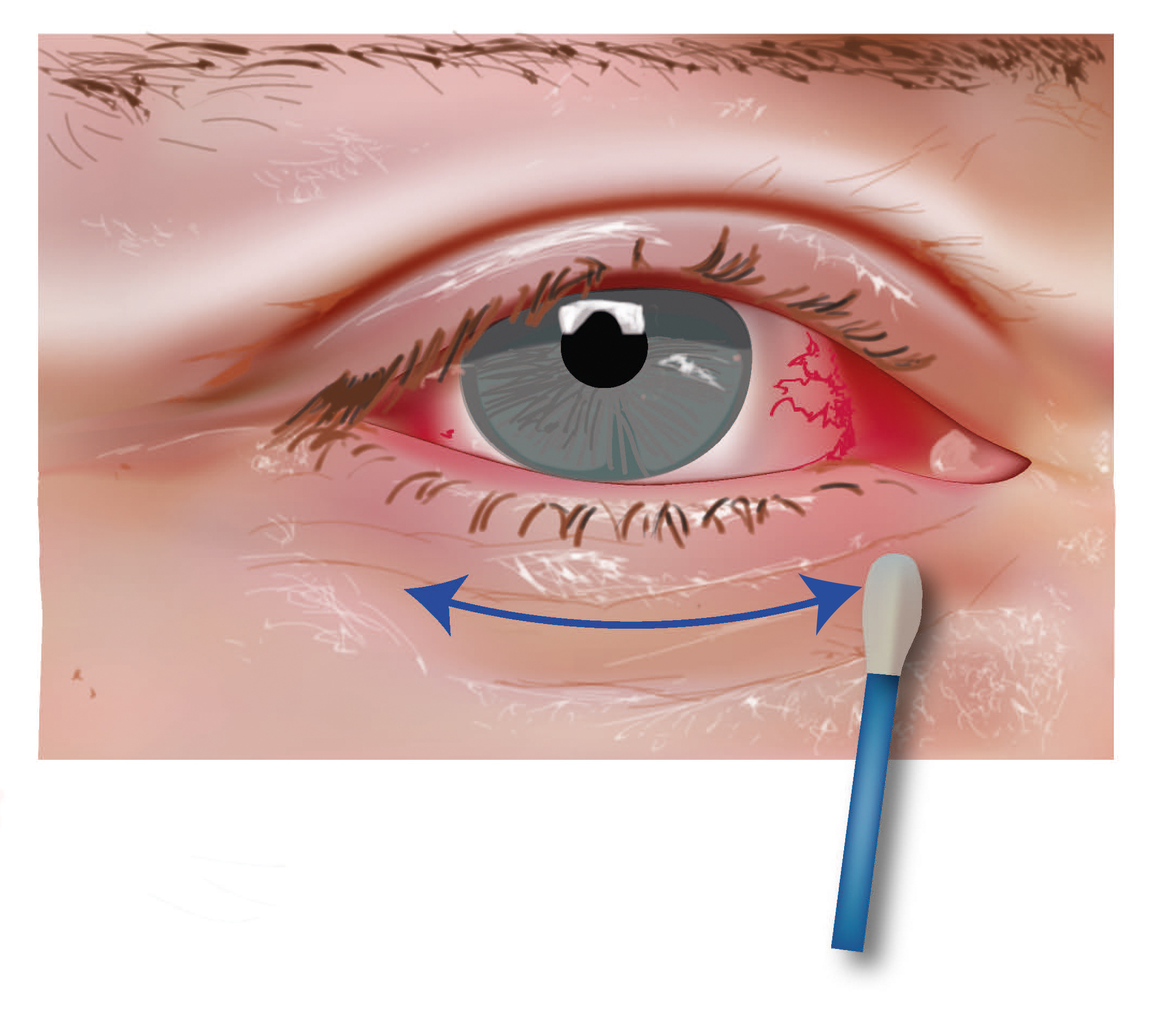 Cleaning your eye with a cotton bud, with a side to side motion