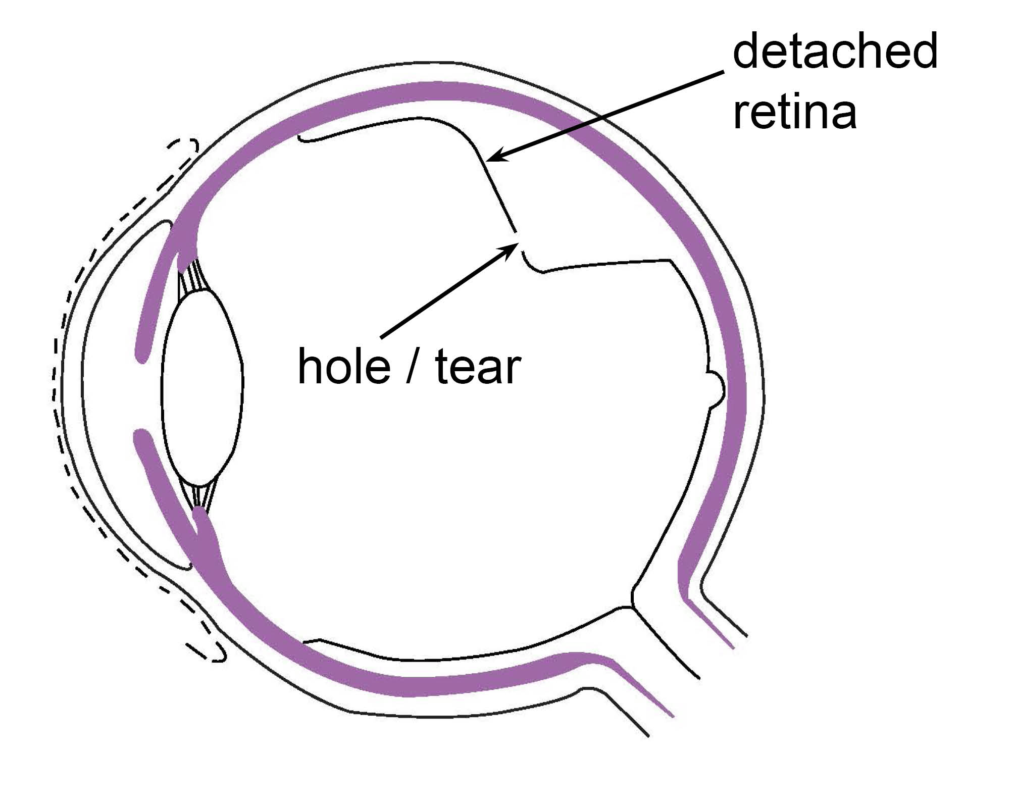 Diagram showing a hole or tear in the retina, allowing fluid from the vitreous cavity to leak in