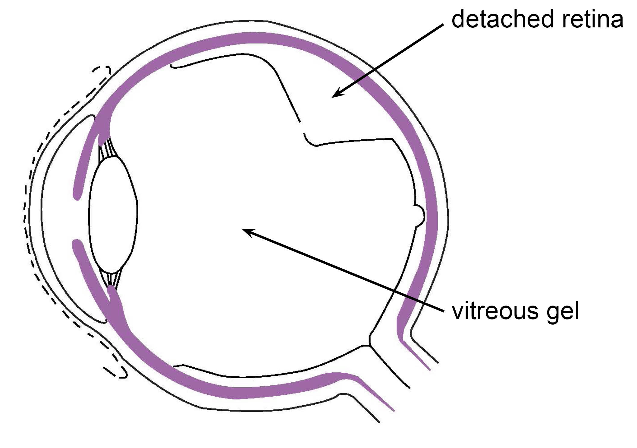 Diagram showing the vitreous gel degenerating and shrinking, pulling away from its attachment to the retina