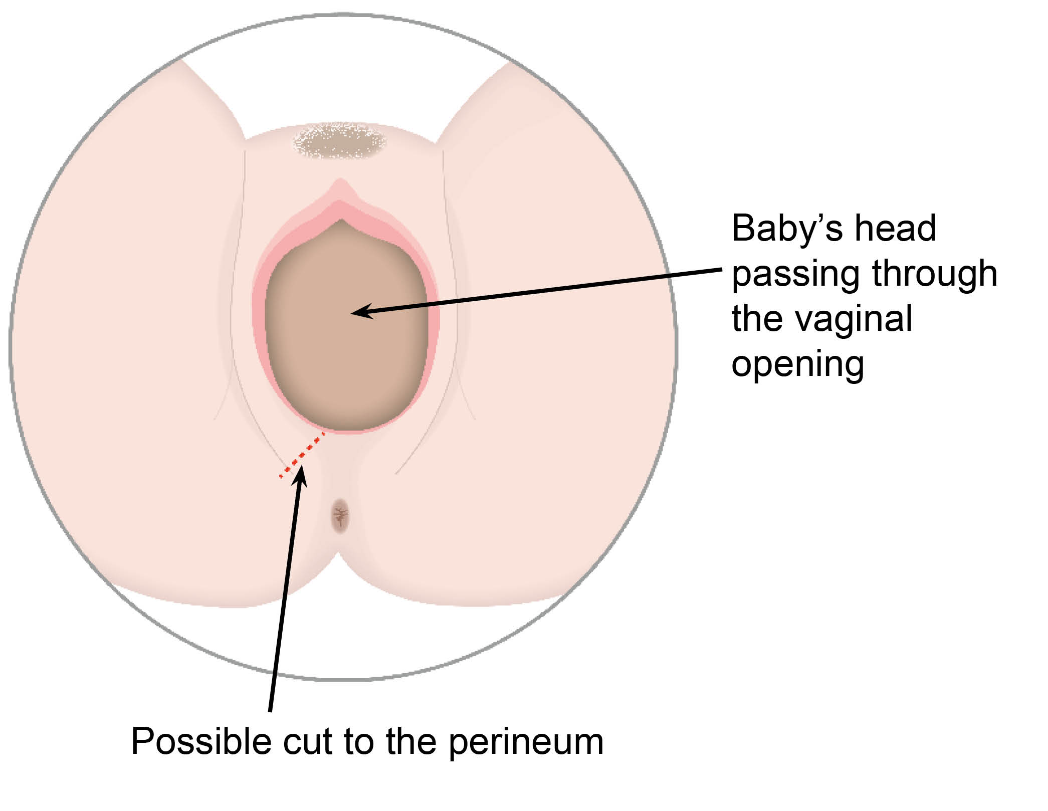 Diagram showing baby's head passing through the vaginal opening, and the possible cut (episiotomy) made by a midwife or doctor