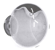 A diagram showing a hole or tear in the retina, allowing fluid from the vitreous cavity to leak in