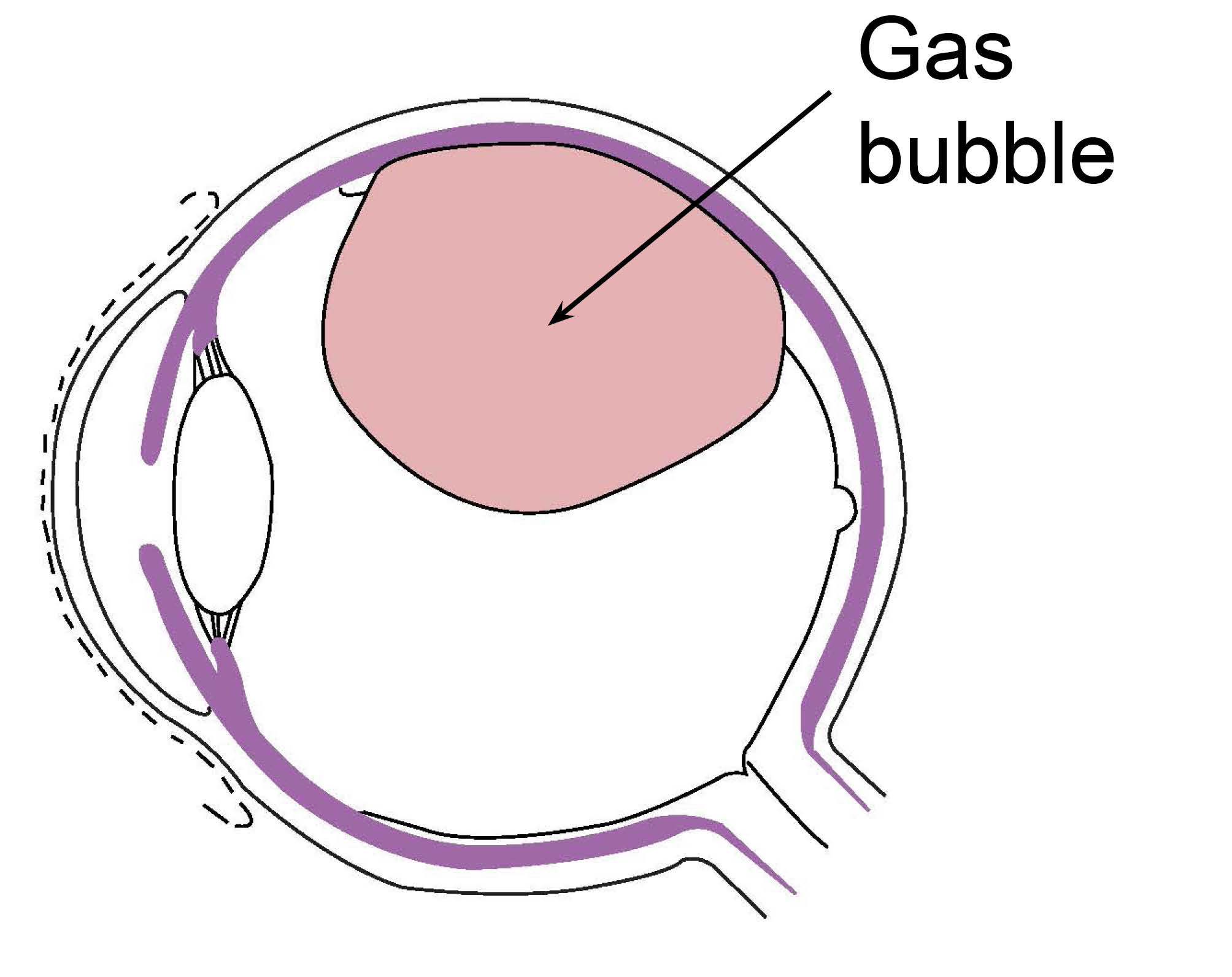 Diagram showing a gas bubble in the eye