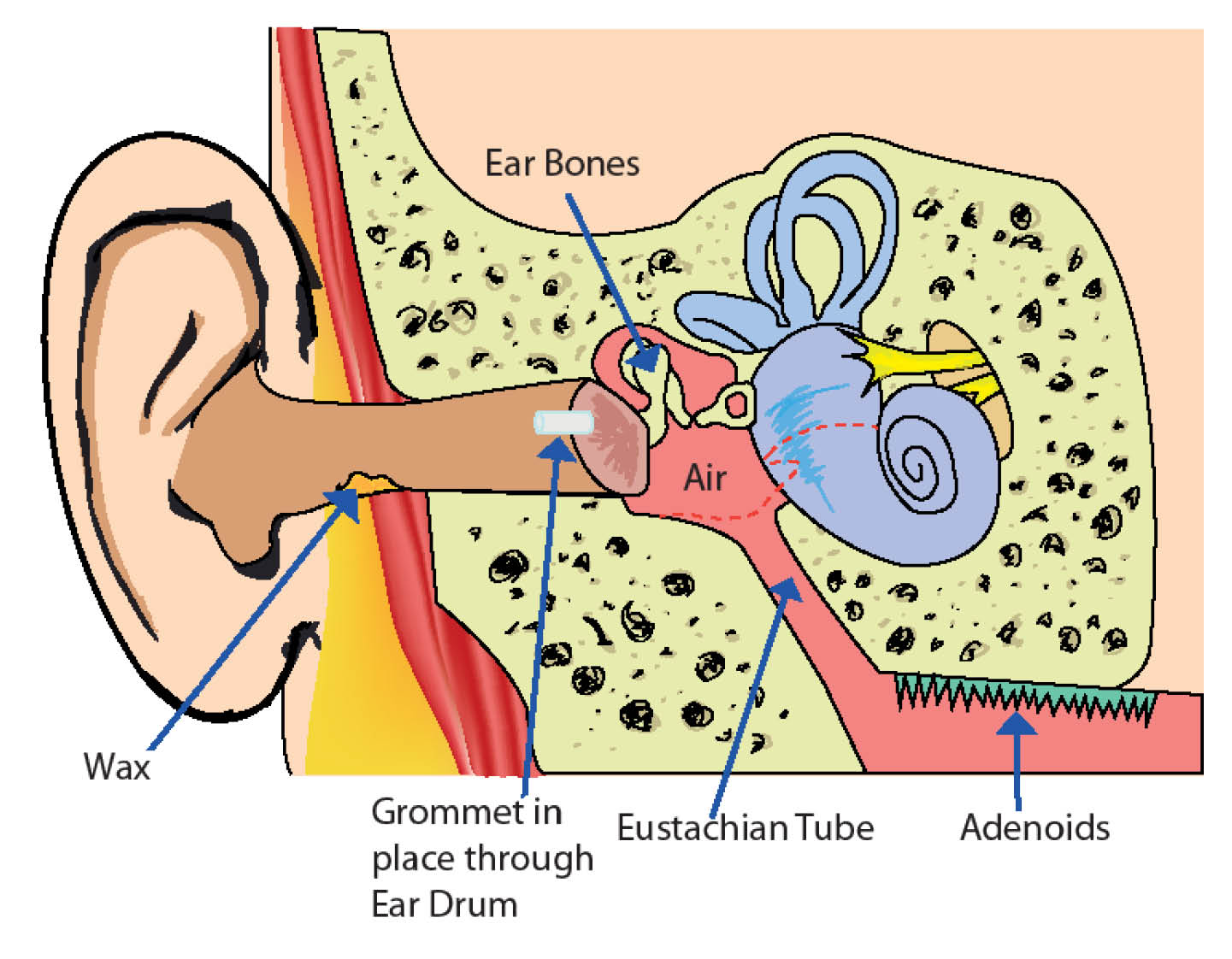 Grommet in place through the ear drum