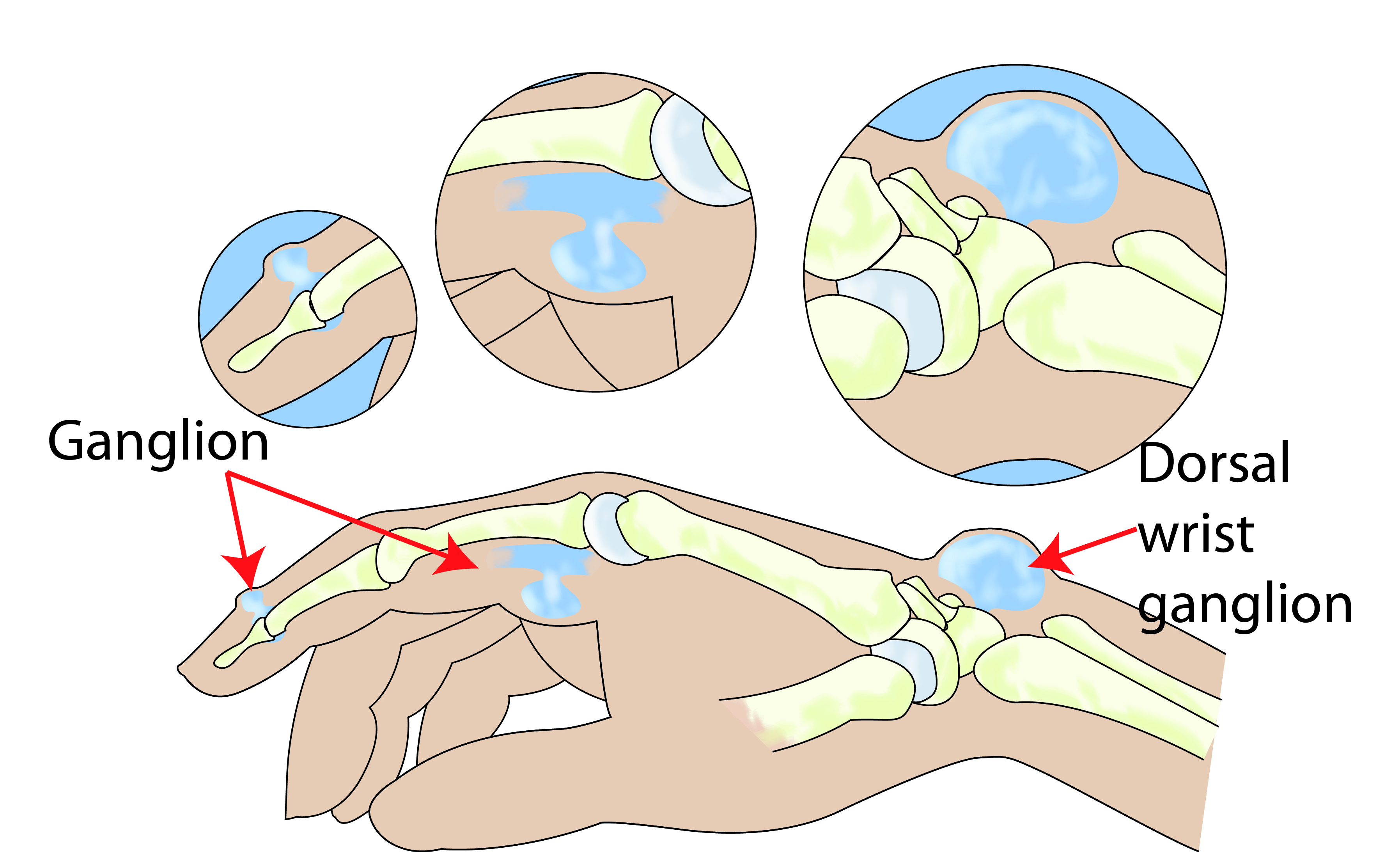 Ganglion on the back of the end joint of a finger, at the base of a finger, and on the wrist