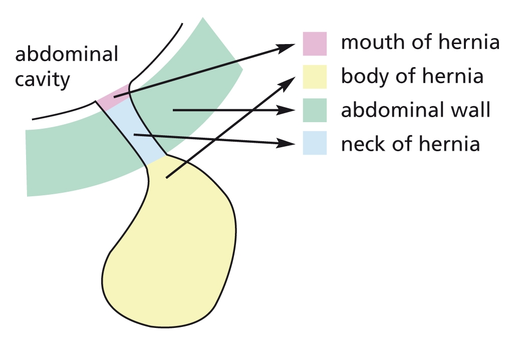 hernia-image-1.JPG