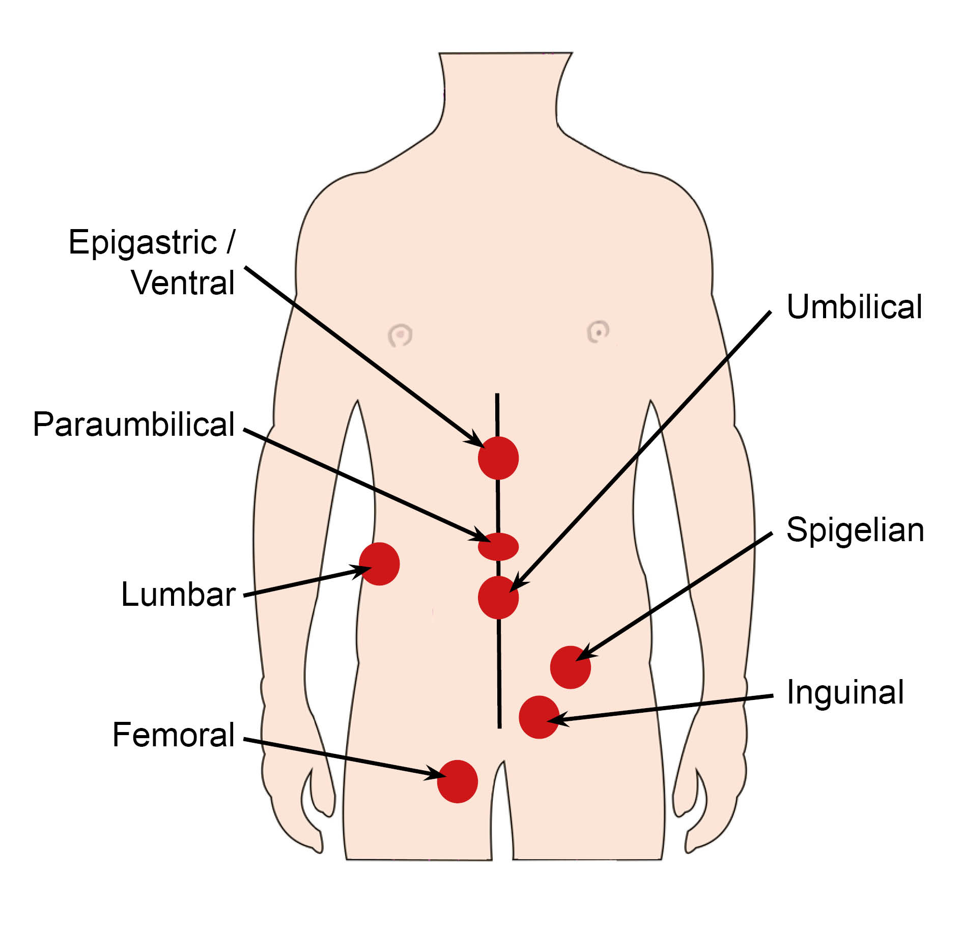 Epigastric / Ventral hernia is found between the bottom of the breast bone and the belly button. Paraumbilical hernia is found at the belly button, but usually off to one side. Lumbar hernia is found down the side of the body. Femoral hernia is found in the groin - the area between the lower part of the abdomen and thigh. Umbilical hernia is found at the belly button. Spigelian hernia is found at the side of the tummy. Inguinal hernia is found in the groin.