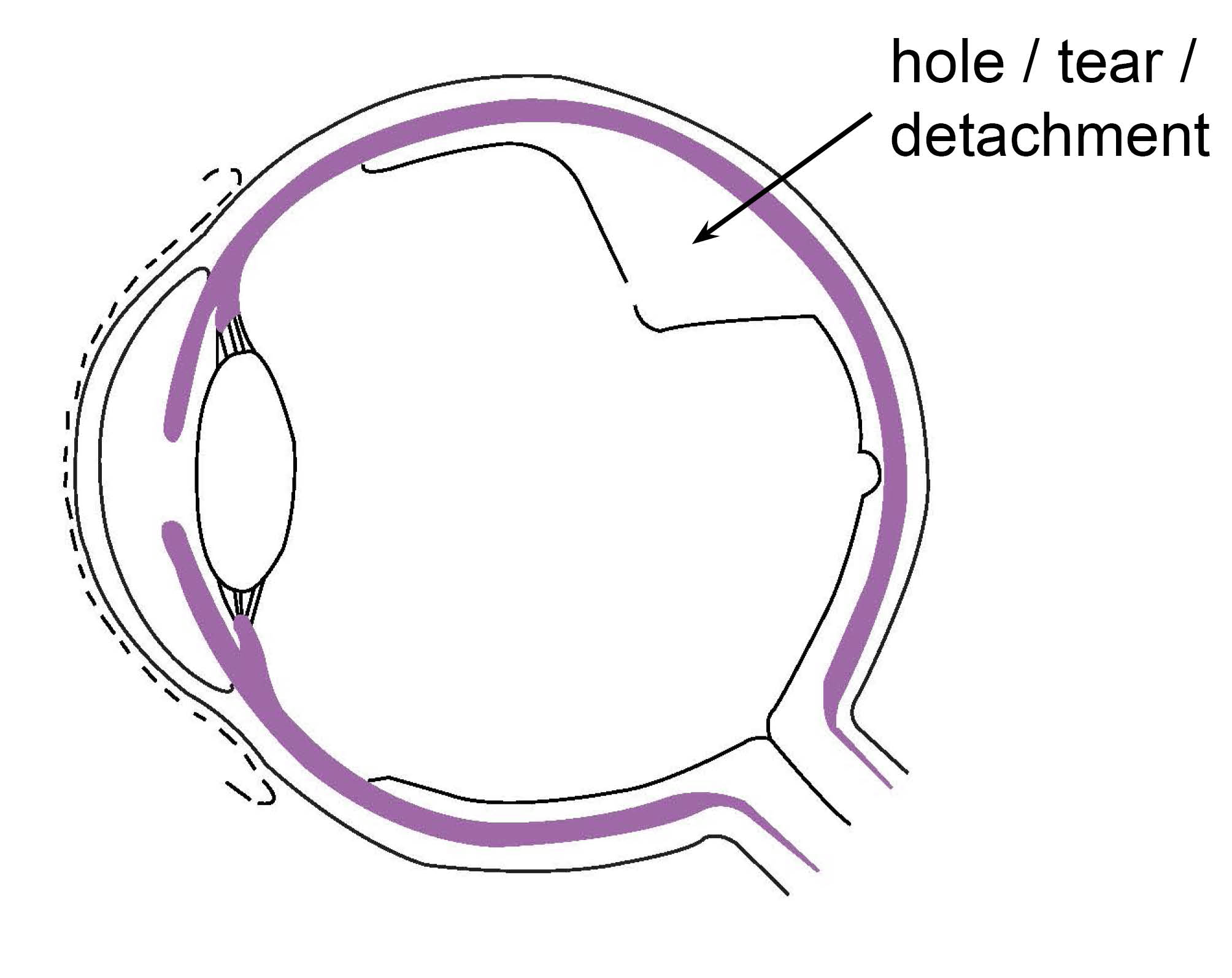 Diagram showing a hole / tear / detachment in the eye