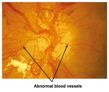 abnormal-blood-vessels-1695202625.jpg