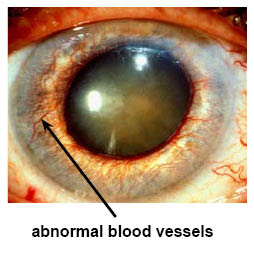 Abnormal blood vessels