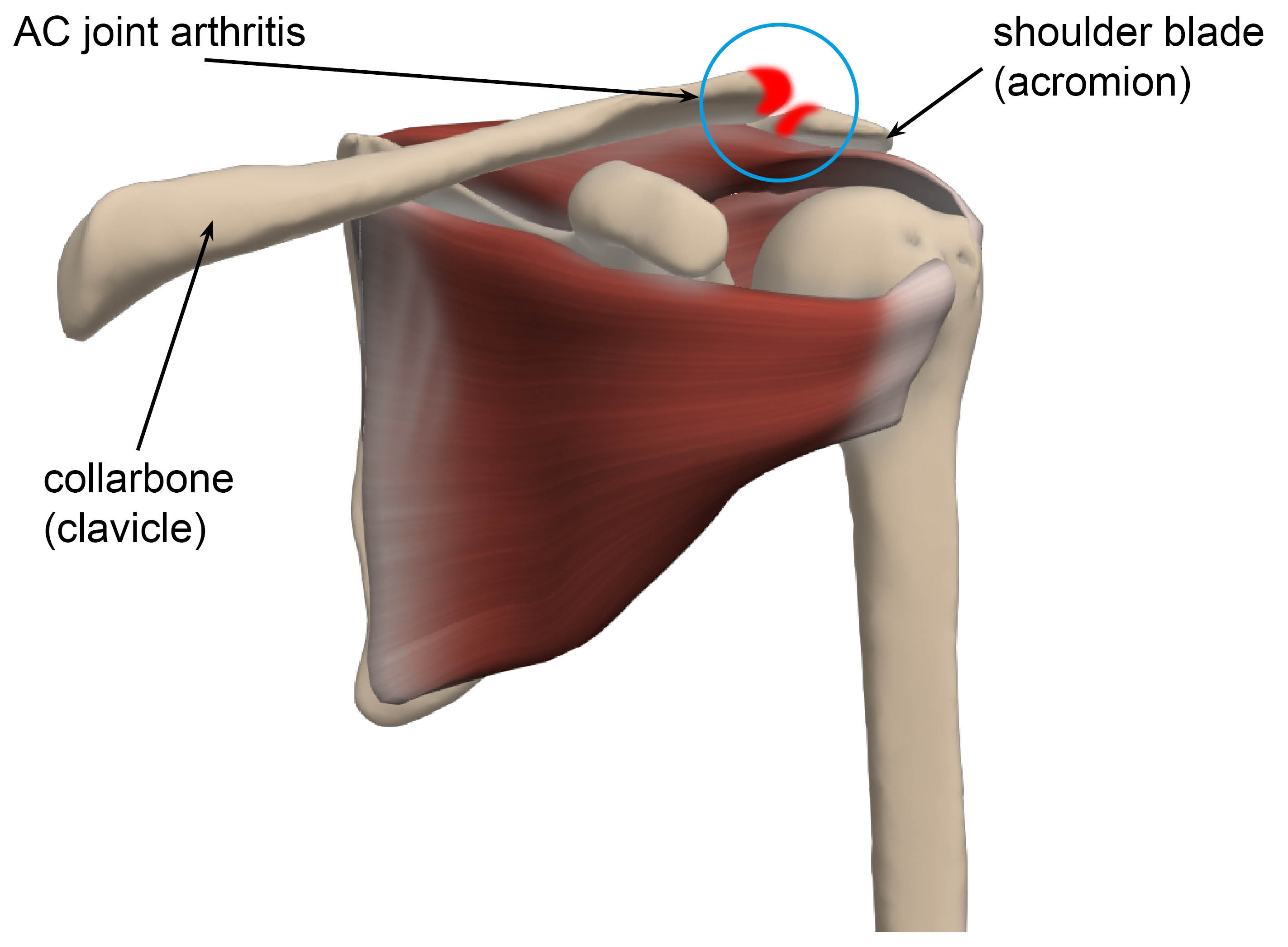 Diagram highlighting acromio-clavicular (AC) joint arthritis