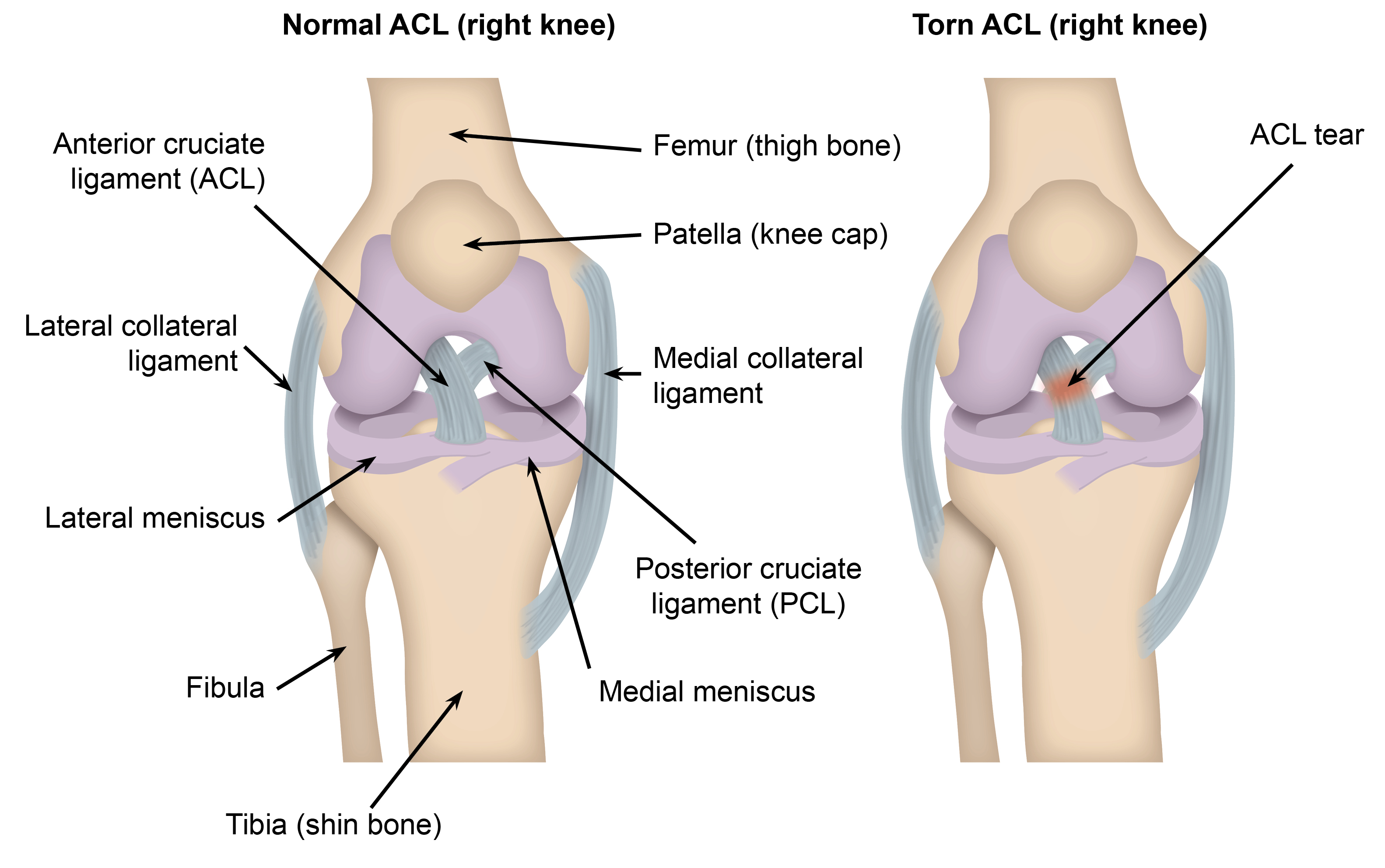 A normal anterior cruciate ligament, compared to a torn anterior cruciate ligament