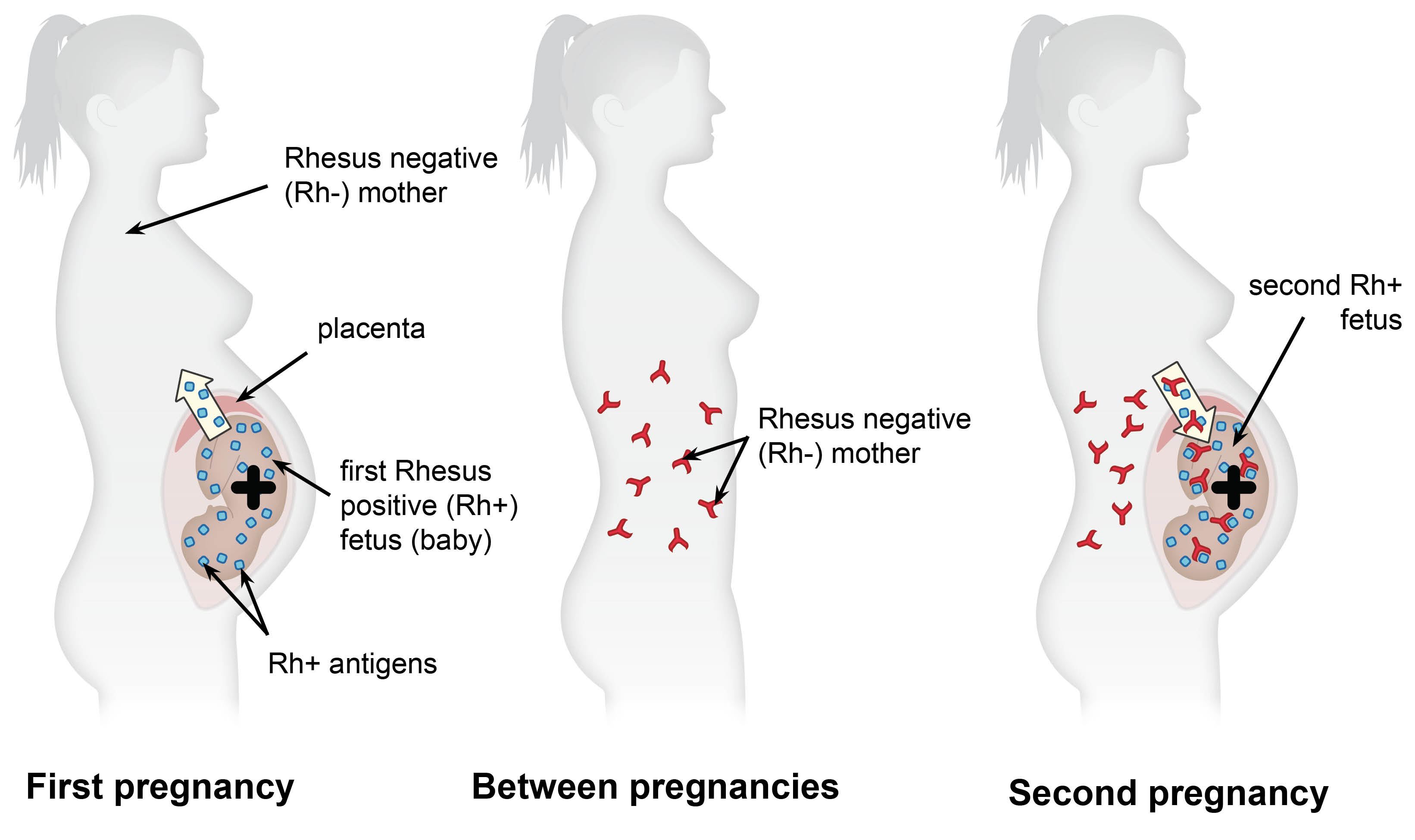 anti-d-pregnancy-with-labels.jpg