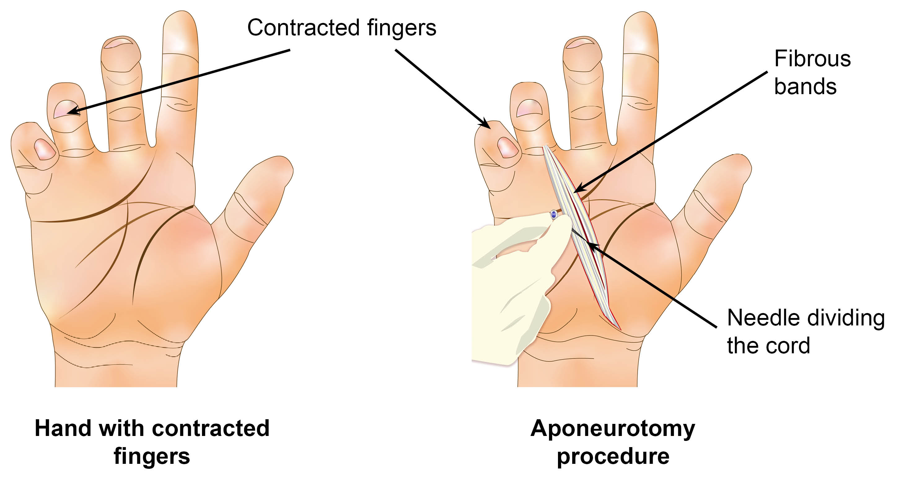 Two diagrams, first showing a hand with three fingers contracted (bent). Second diagram shows a surgical cut from the ring finger to the base of the thumb. The fibrous bands are exposed, and a needle to dividing the bands.