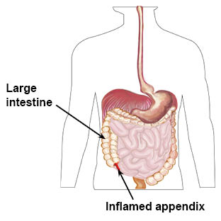 appendix-inflamed-with-labels.jpg
