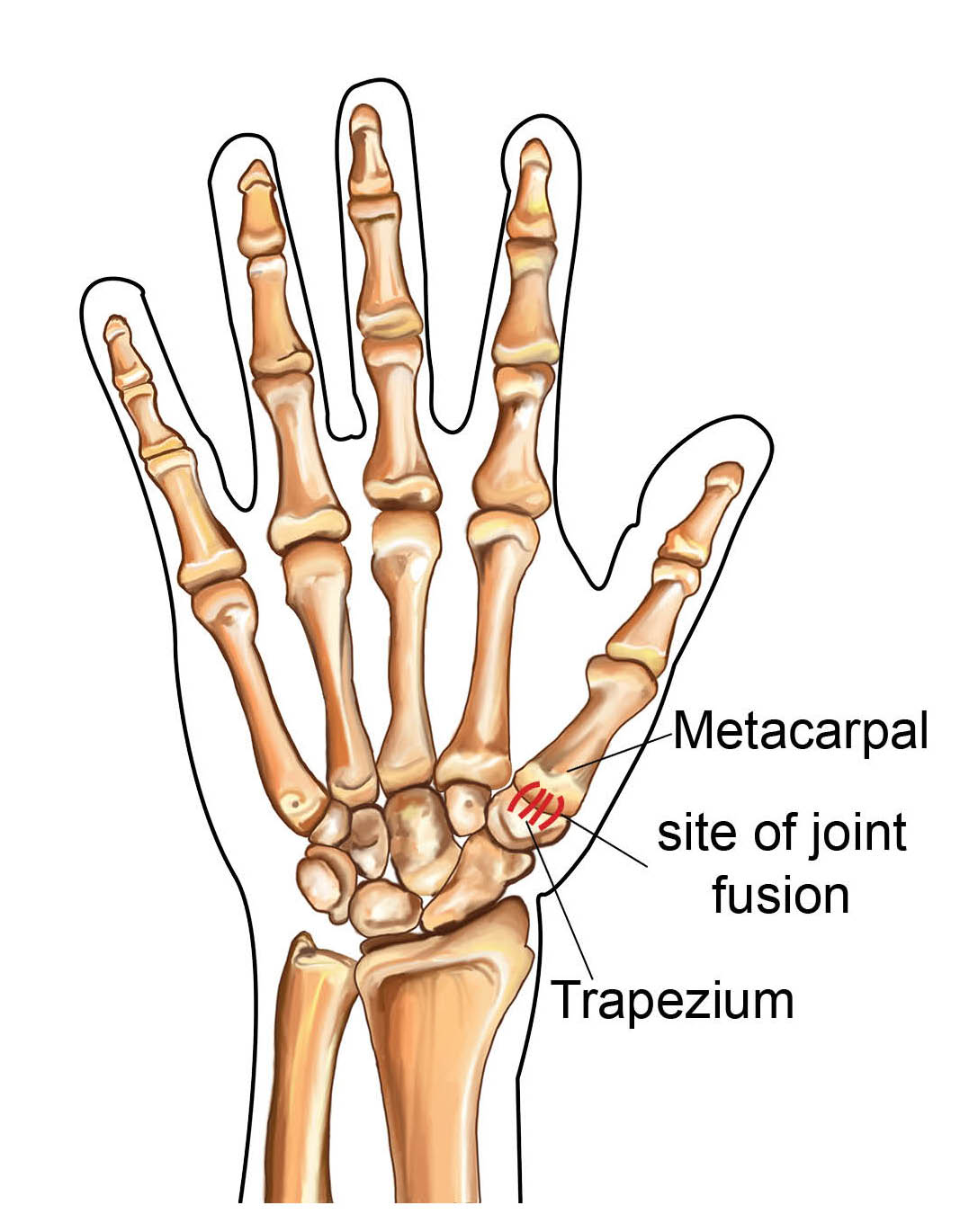 arthrodesis-medphoto.jpg