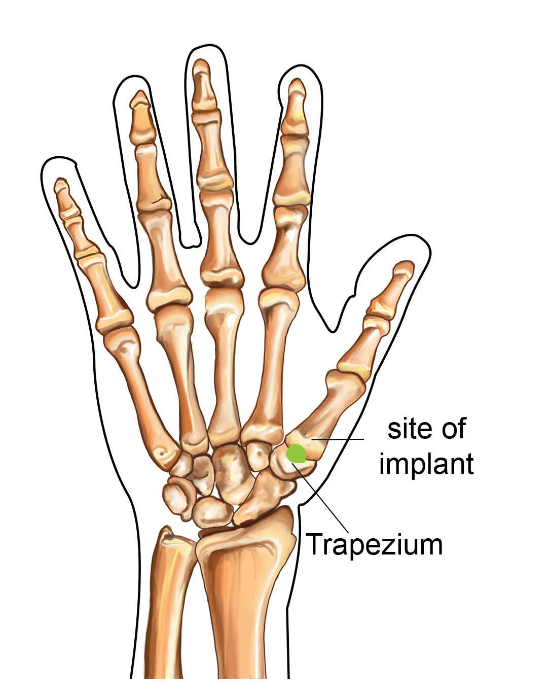 Diagram showing the position of the Cartiva implant at the base of the thumb joint.