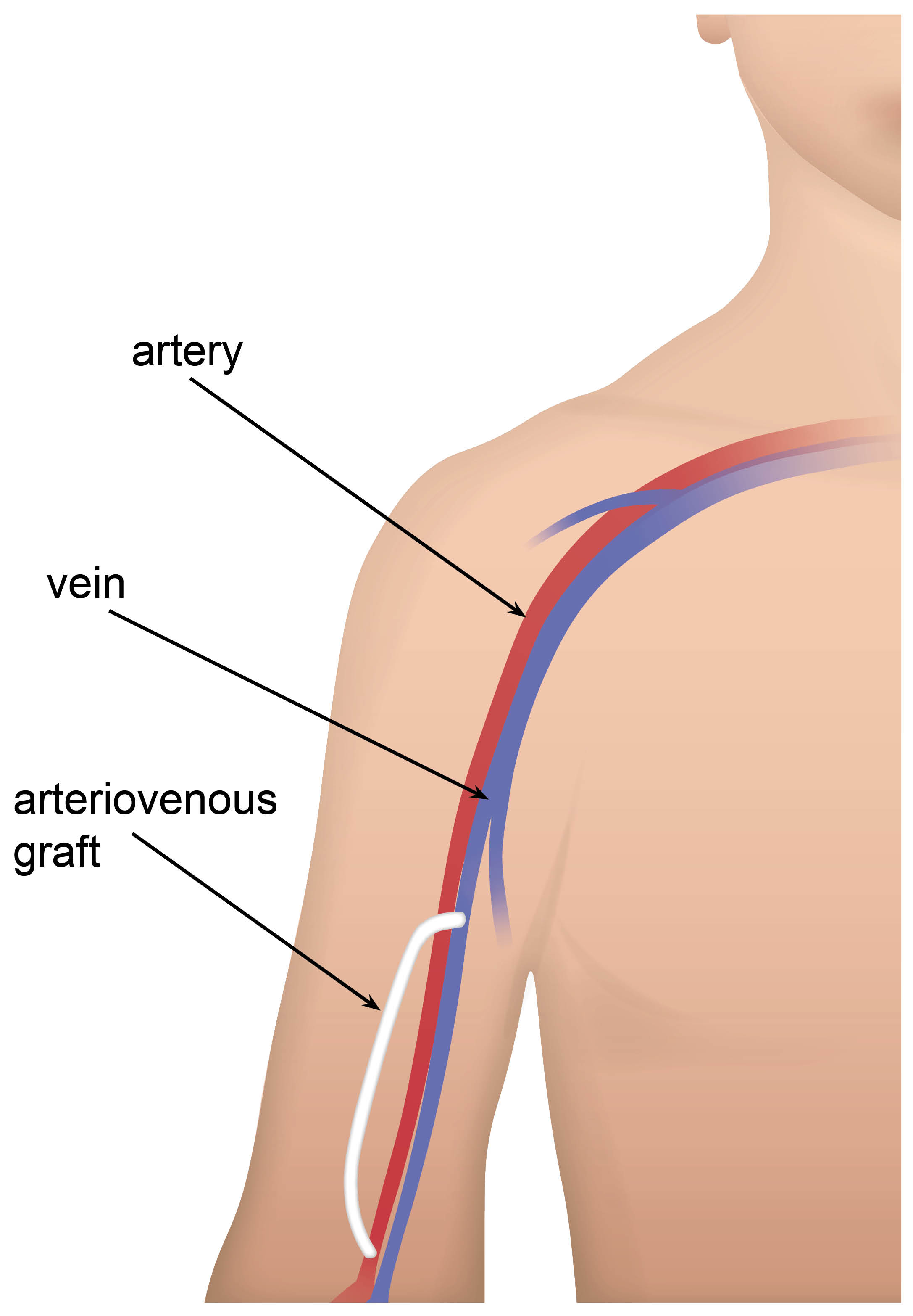 av-graft-(arm)-with-labels.jpg