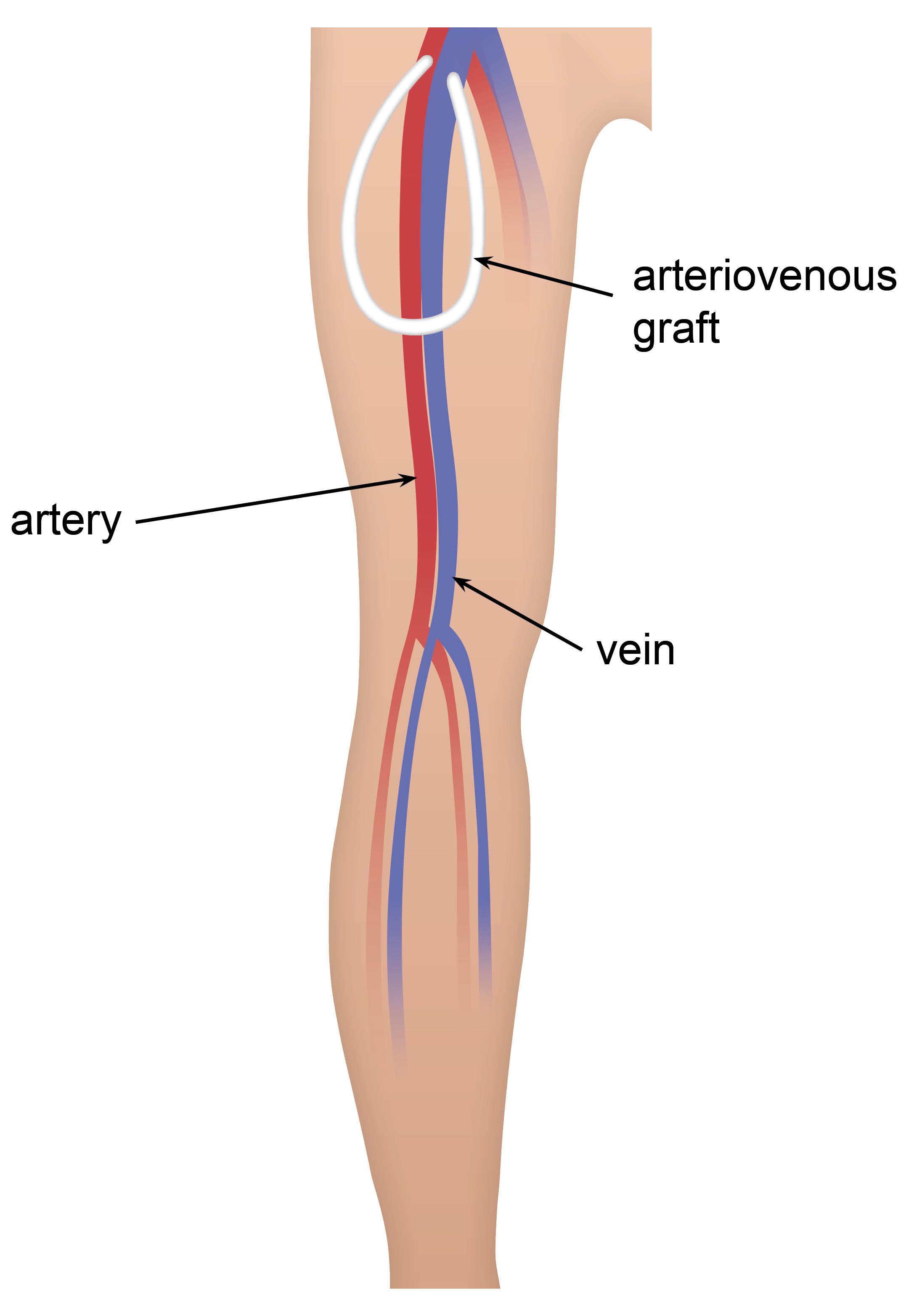 av-graft-(leg)-with-labels.jpg