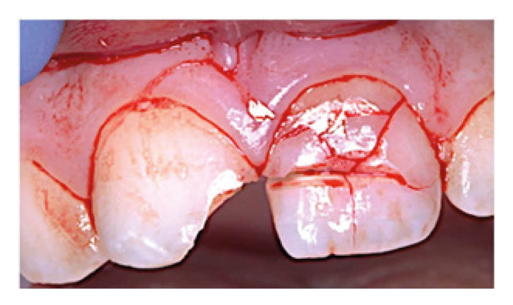 Broken / fractured teeth