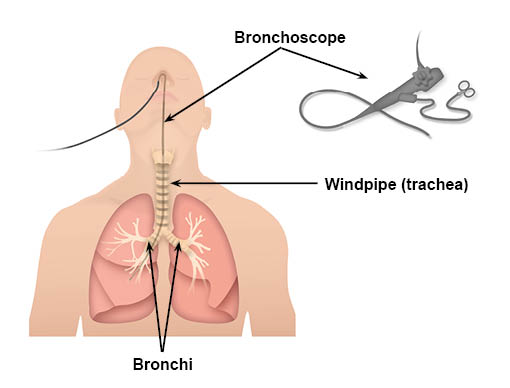 Diagram showing the bronchoscope going through the nose, down the windpipe and into the bronchi