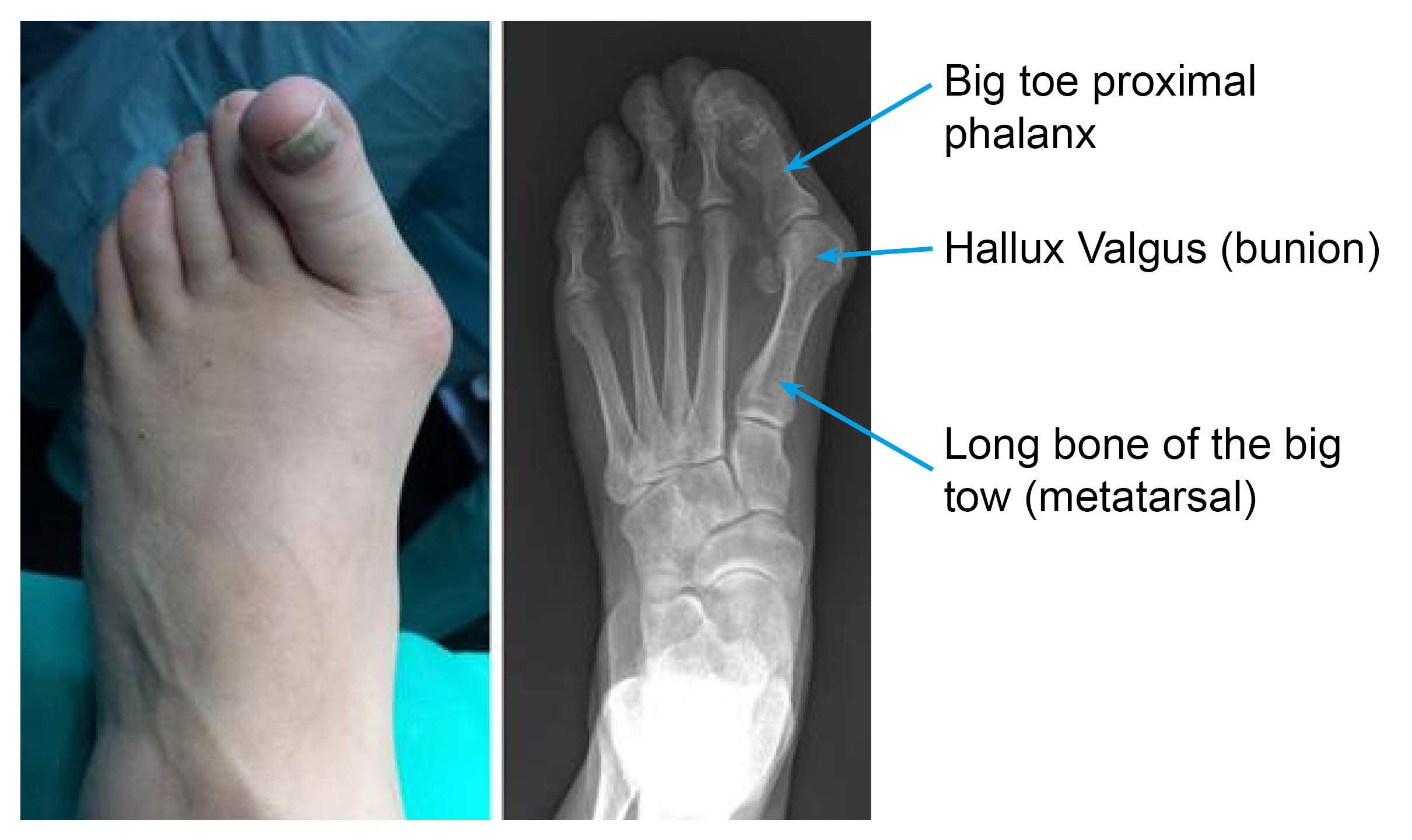 Photo of a left foot with a bunion, alongside the x-ray of the same foot. The x-ray shows the deformity of the long bone of the big toe deviating away from the second toe metatarsal.