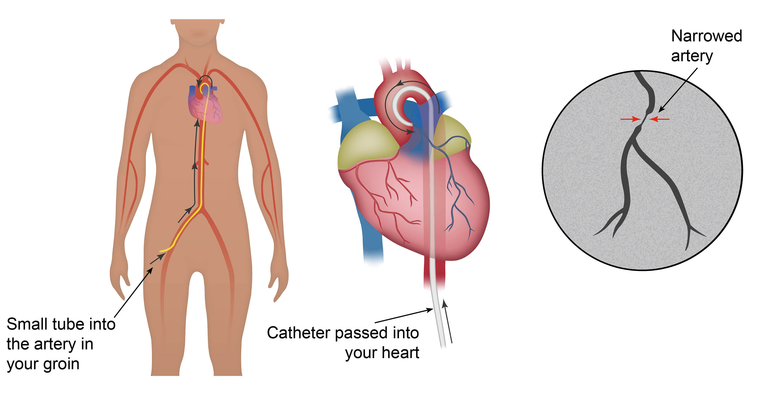 Diagram showing a small tube (sheath) going into the artery in your wrist. Through this sheath a catheter will be passed up to your heart.