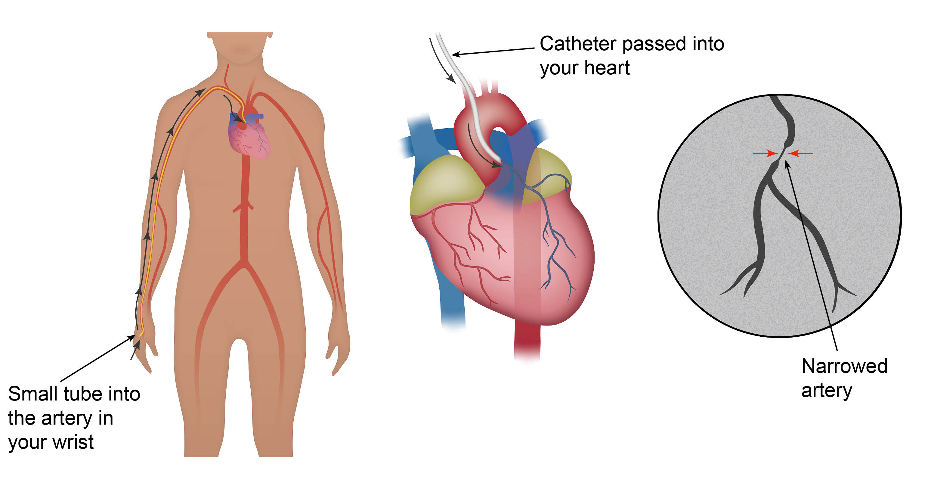 Diagram showing a small tube (sheath) going into the artery in your wrist. Through this sheath a catheter will be passed up to your heart.