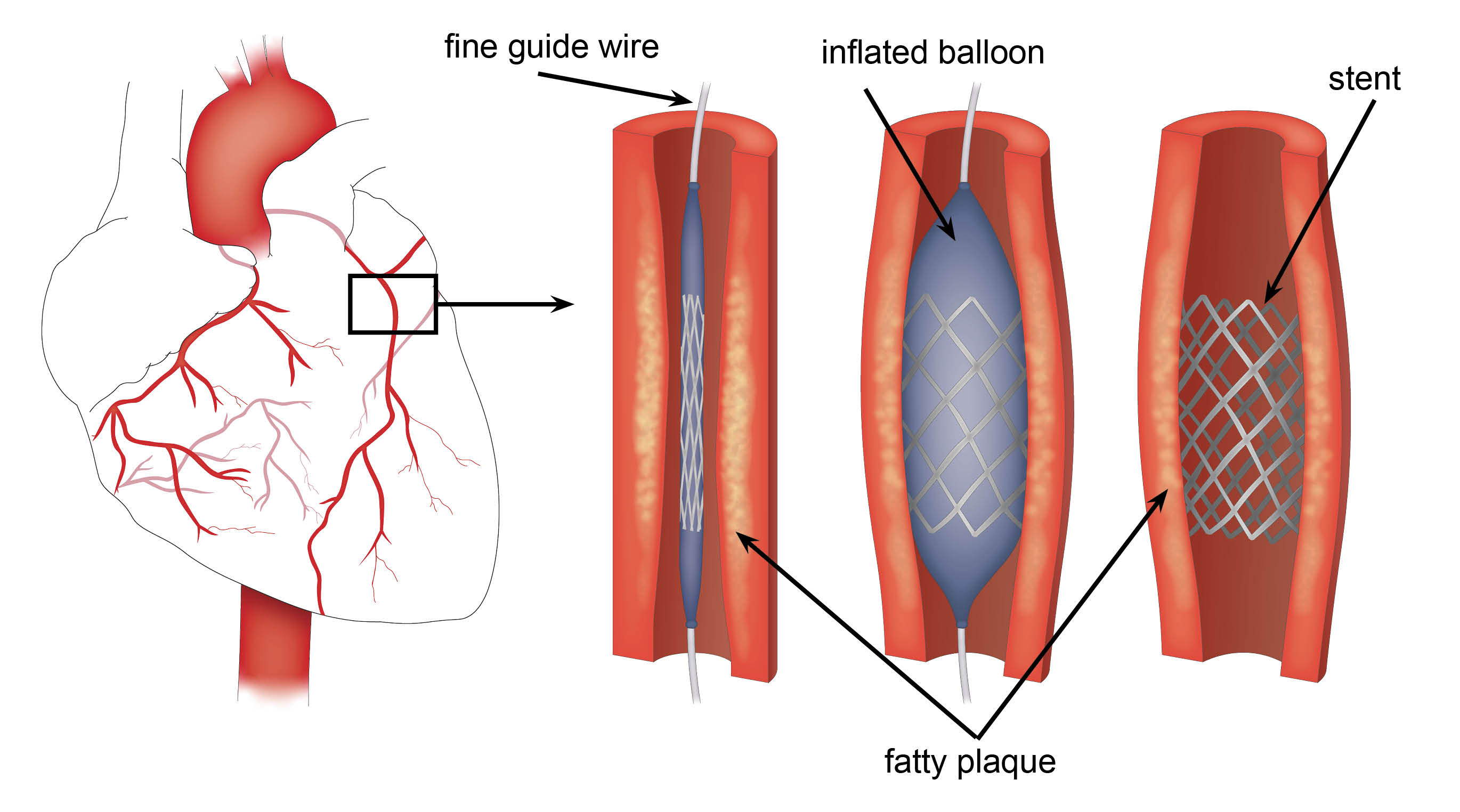 cardiac-intervention-with-labels-1741697434.jpg