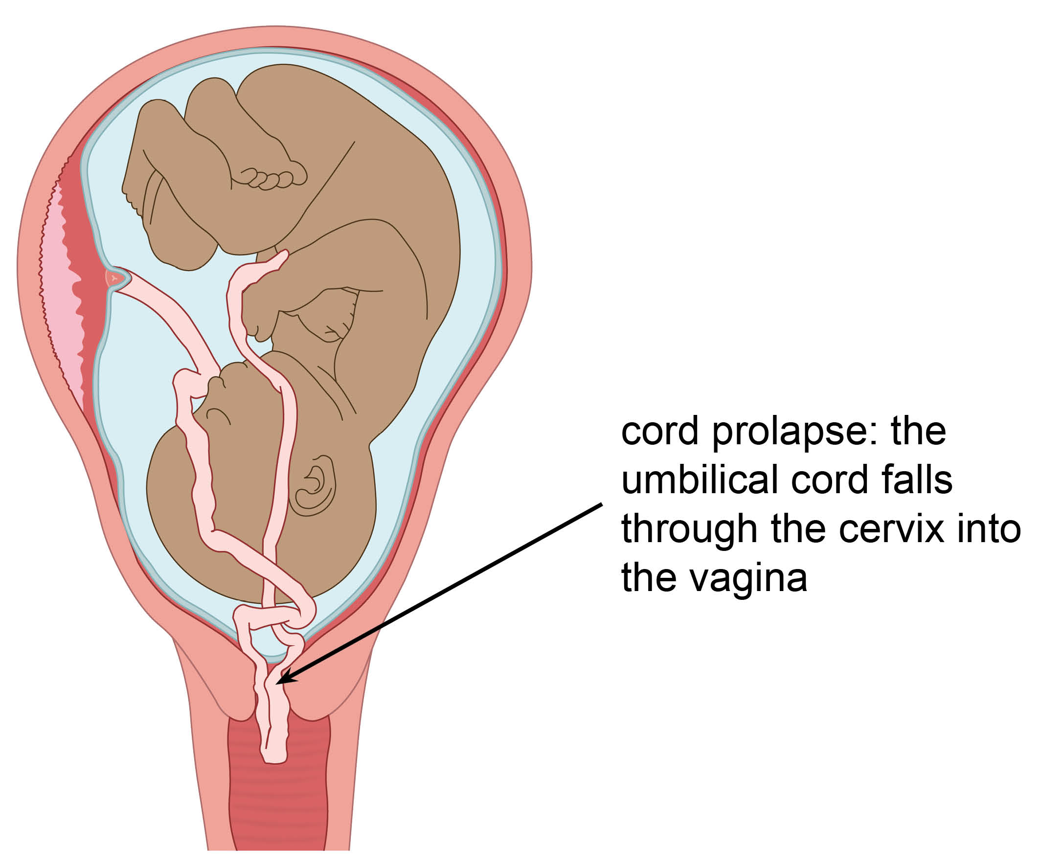 Diagram showing the umbilical cord falling through the cervix into the vagina (prolapse)