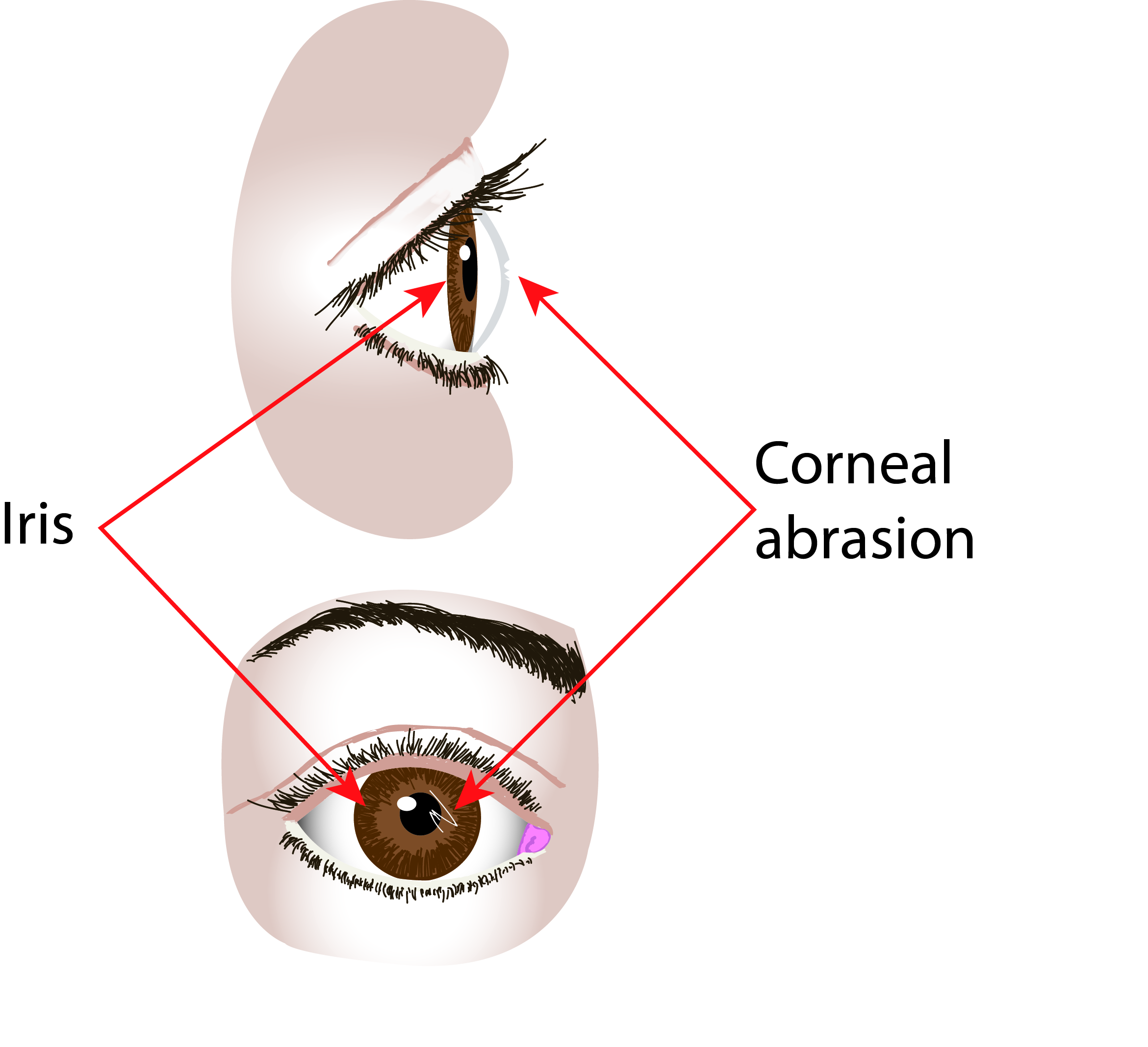 Diagram showing a scratch (damage) to the clear tissue covering the front of your eye, called the cornea.