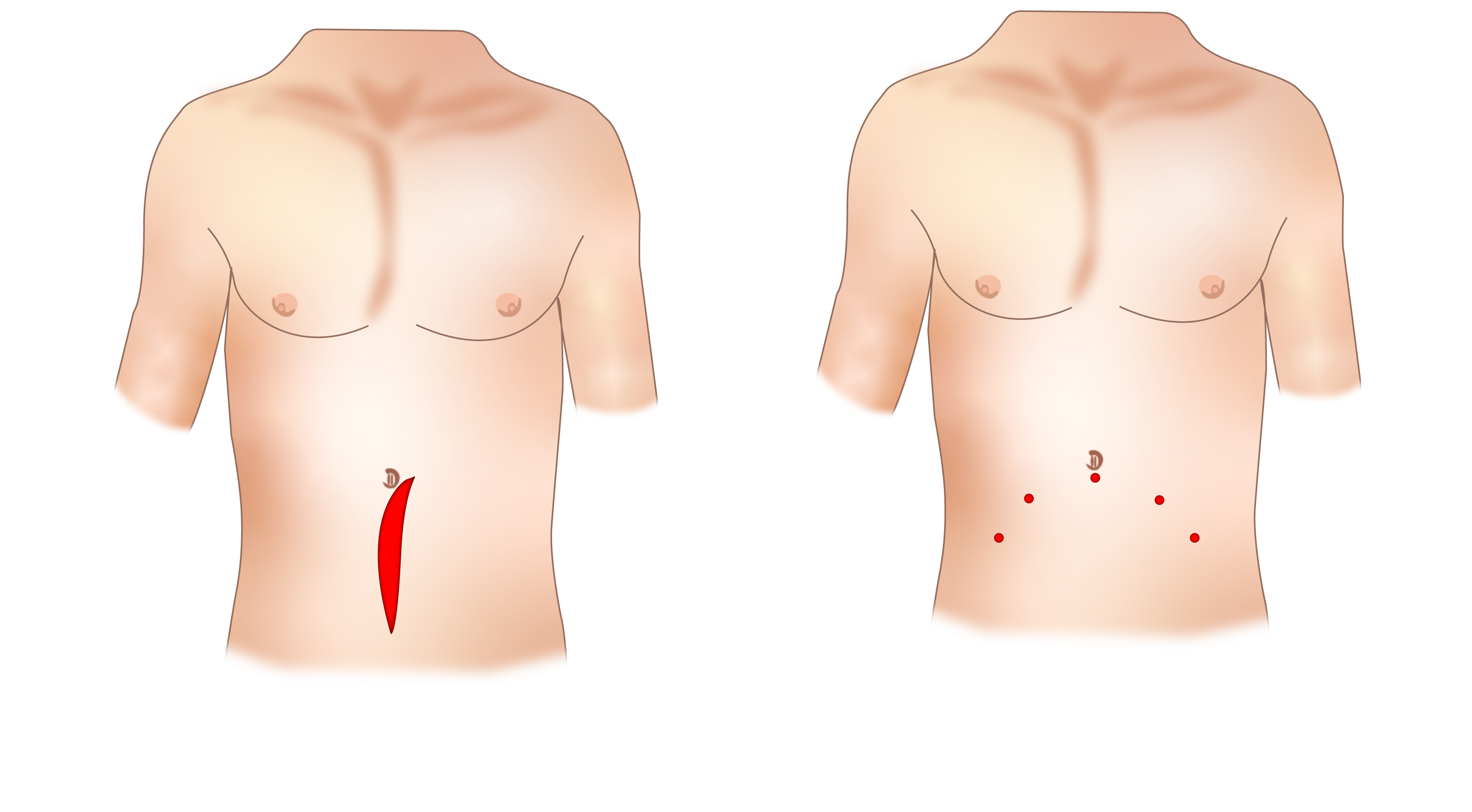 Diagram showing a surgical cut from the navel (belly button) downwards to groin, compared to the five small incisions made by da Vinci® on the abdomen