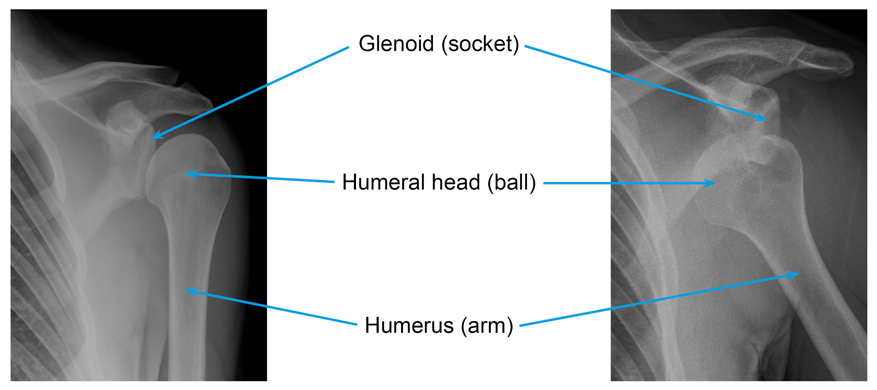 X-rays showing a normal shoulder compared to a dislocated shoulder