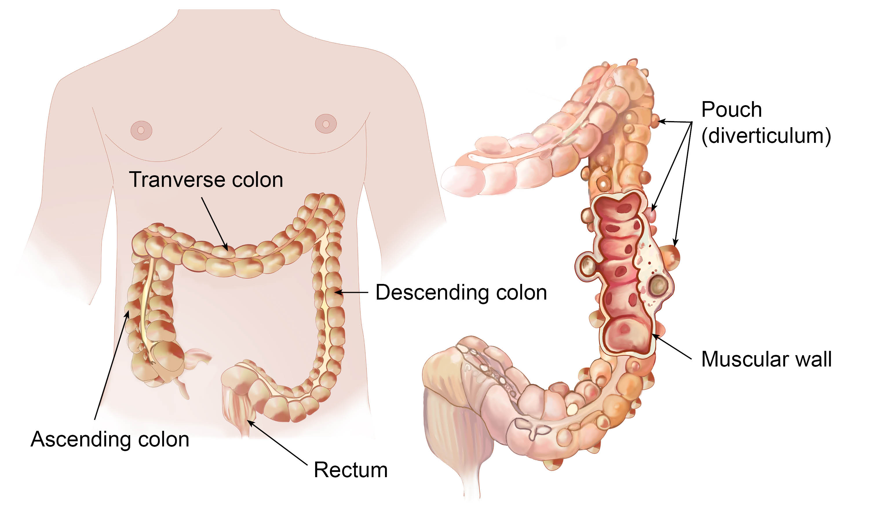 Pouches (diverticulum) in the colon