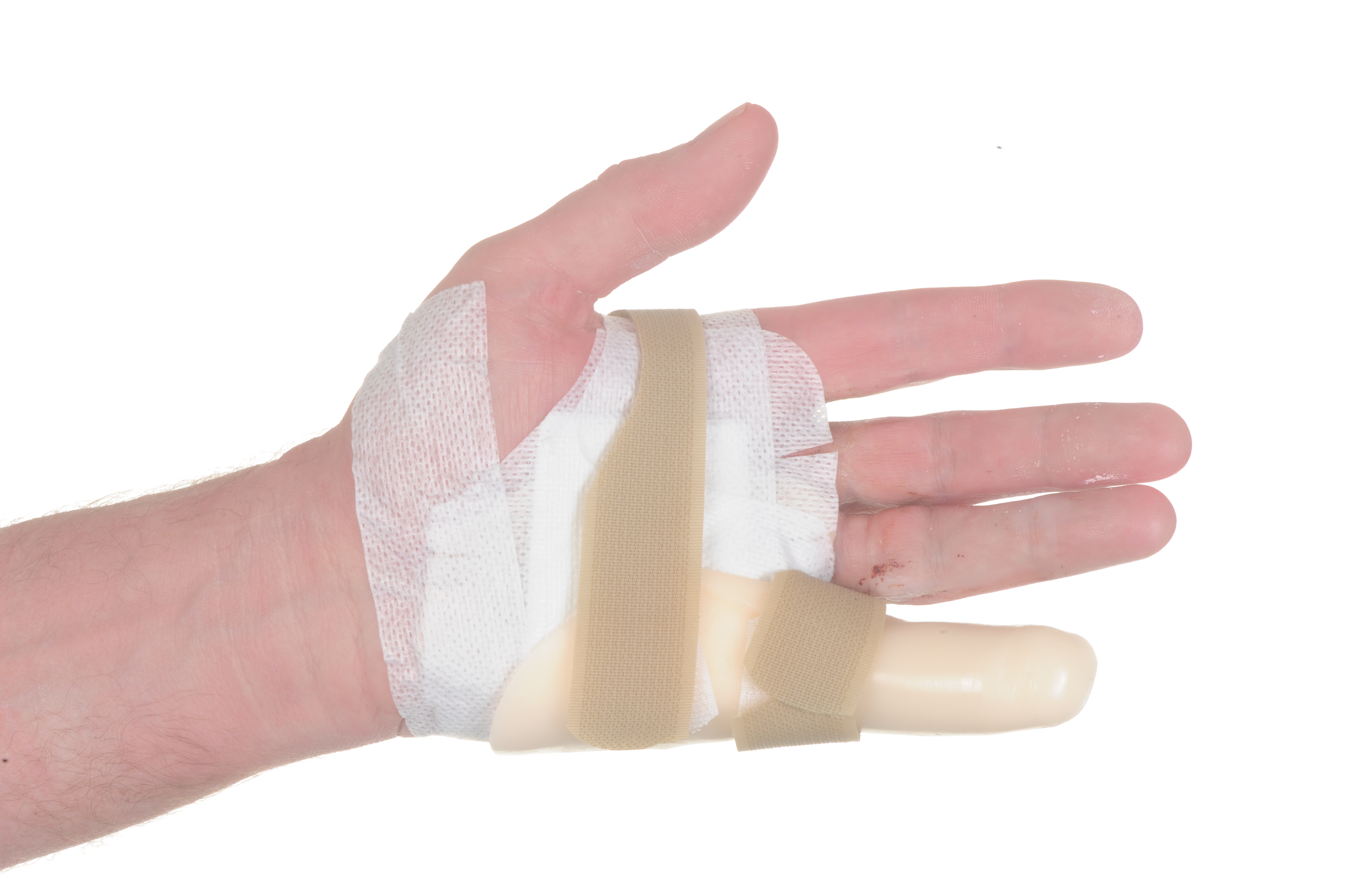 Hand with dressing over surgical wound, and a splint over the little finger supported by a Velcro strap.