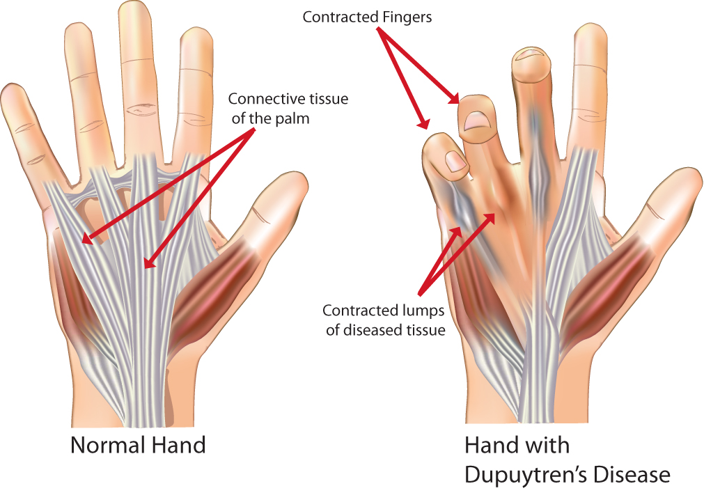 Two diagrams, one showing a 'normal' hand with the connective tissue in the palm, running from the wrist to the fingers. The second diagram shows the same tissue diseased, causing lumps in the tissue resulting in the fingers contracting (bending over).