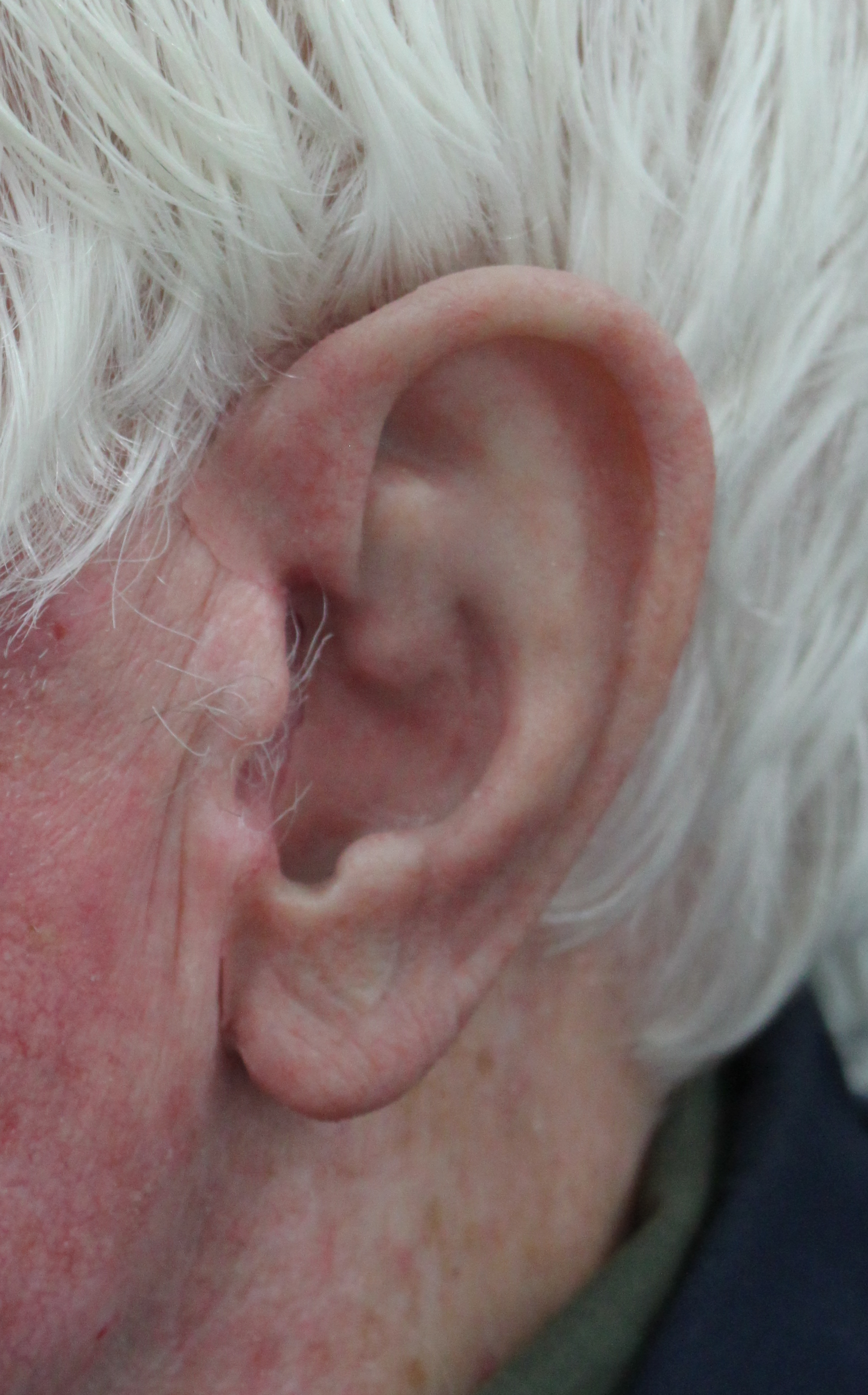 ear-prosthesis-medphoto.png