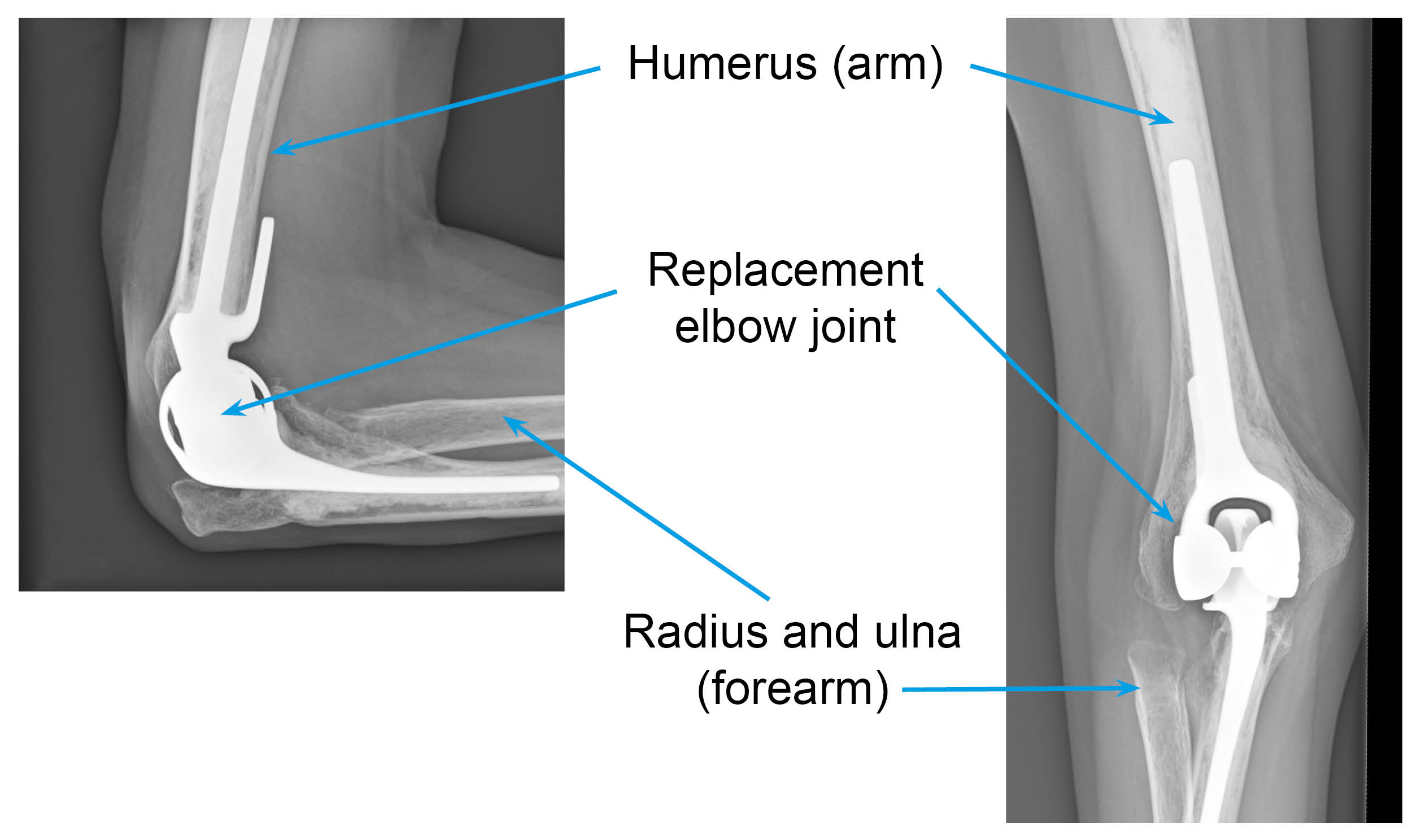 X-rays showing total elbow replacement. X-ray on left shows the side view, and the x-ray on the right shows the front view