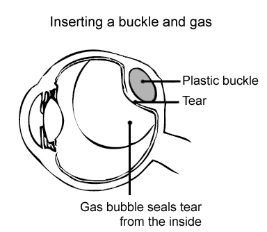 Diagram showing a buckle and gas inserted