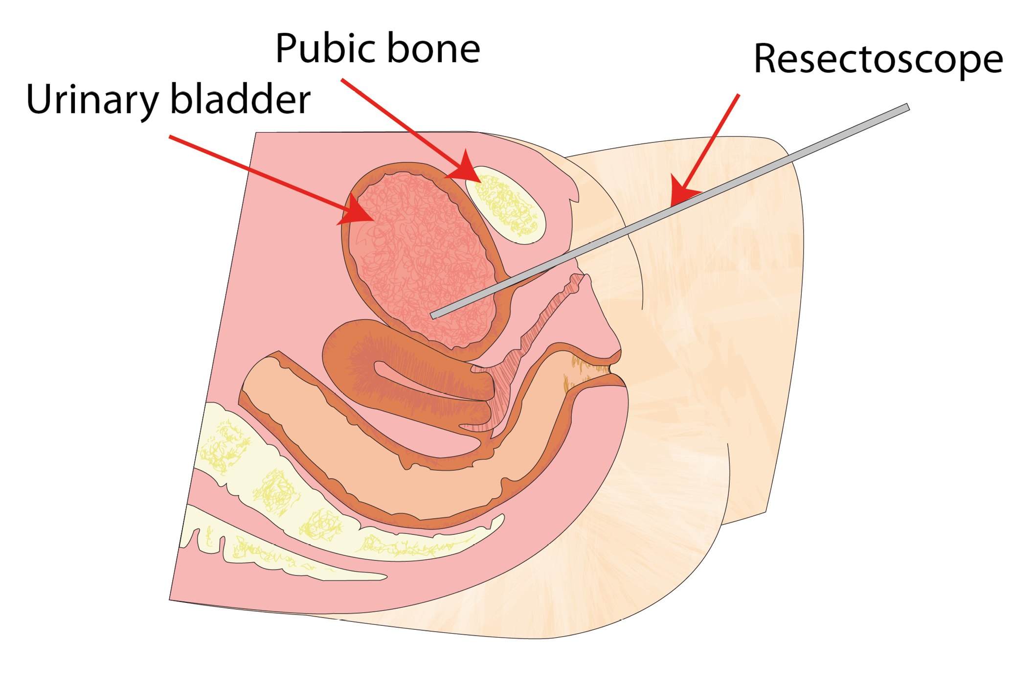 Resectoscope being passed up into the female urethra